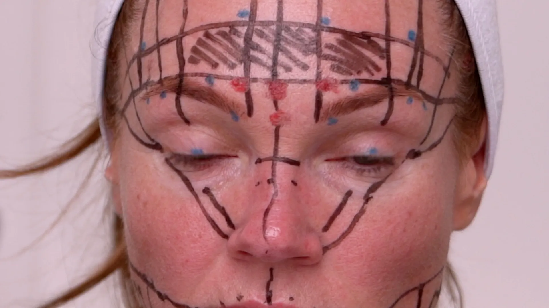 Face & Neck Map 200-UnitS Of Korean Toxin Dehantox - treatment image