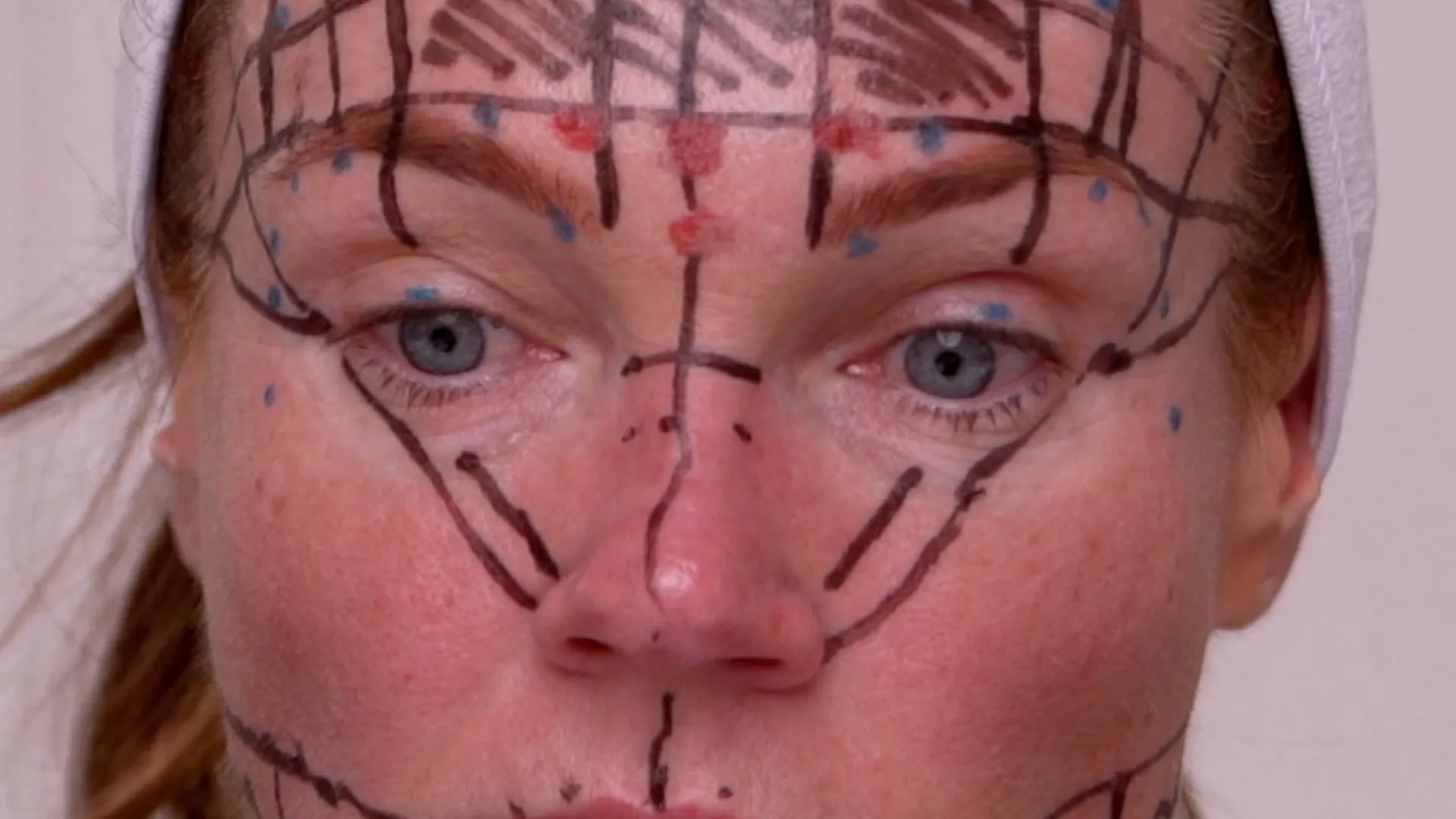 Face & Neck Map 200-UnitS Of Korean Toxin Dehantox - treatment image
