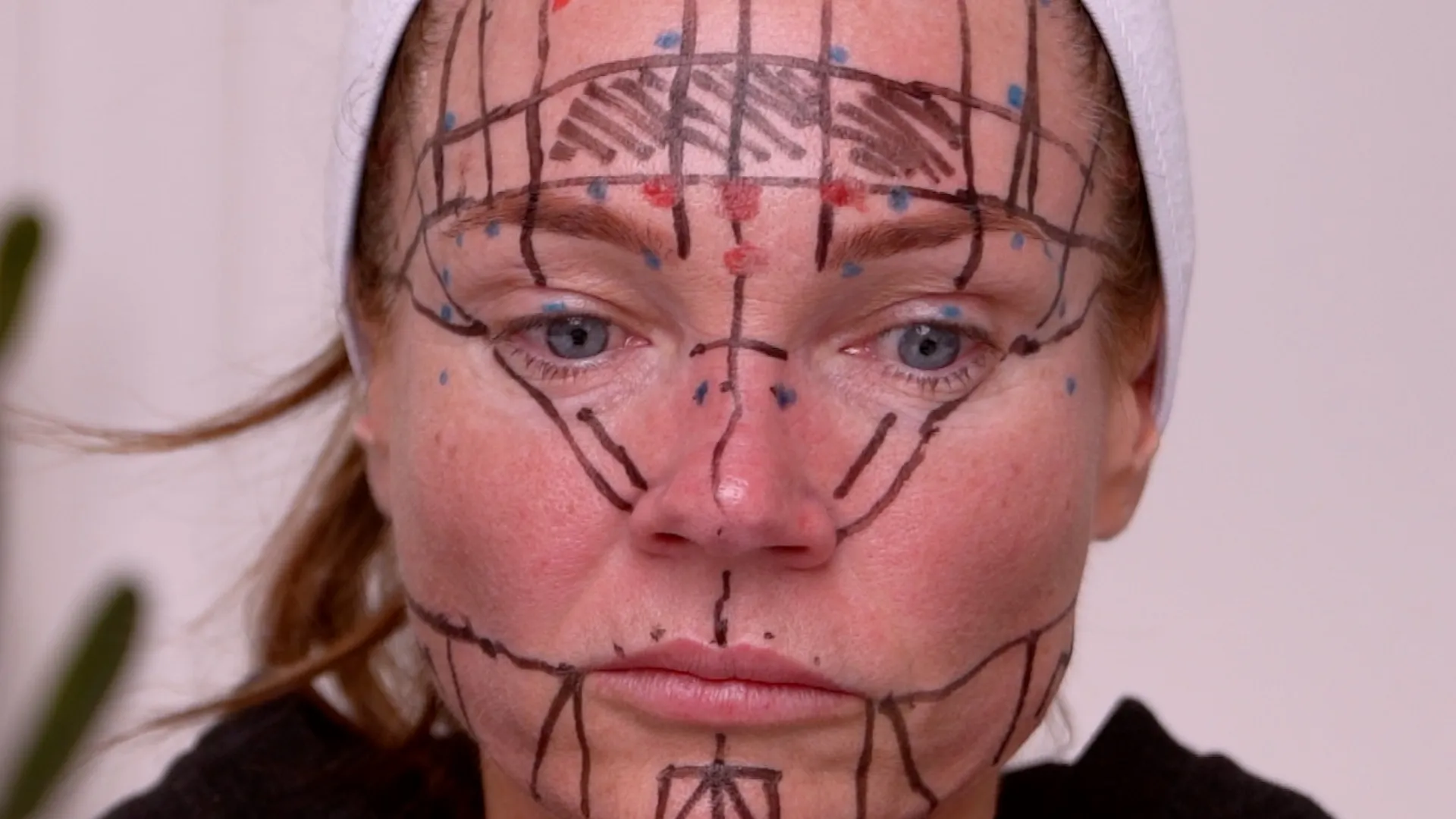 Face & Neck Map 200-UnitS Of Korean Toxin Dehantox - treatment image