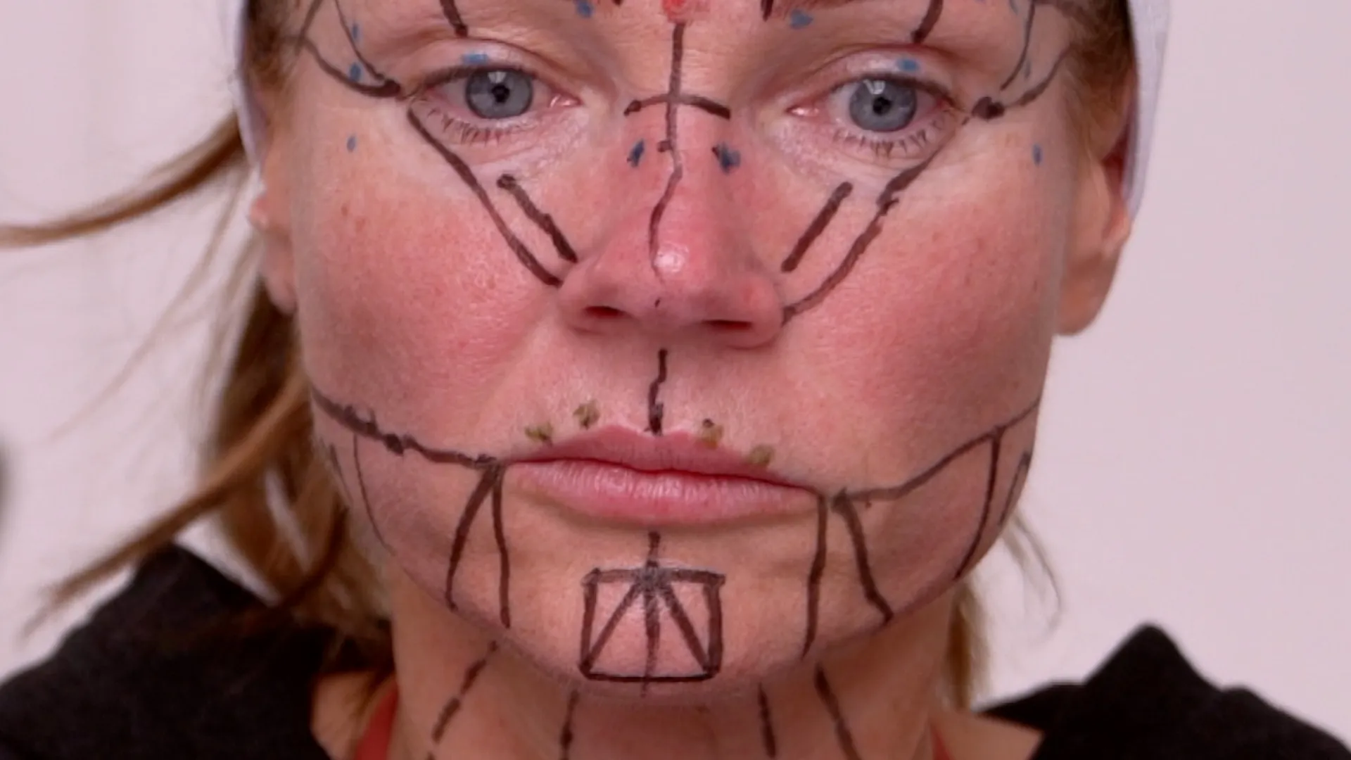 Face & Neck Map 200-UnitS Of Korean Toxin Dehantox - treatment image