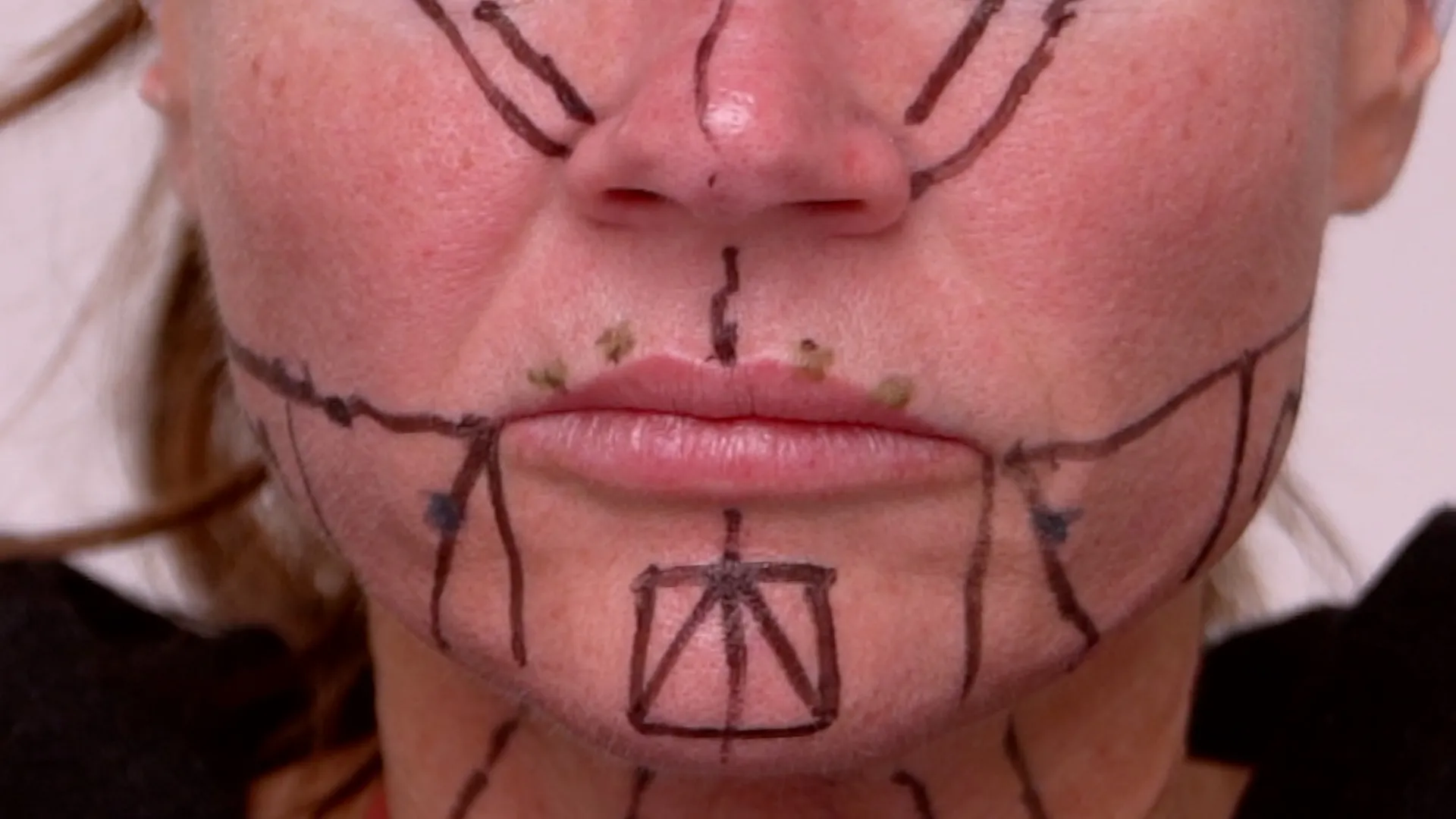 Face & Neck Map 200-UnitS Of Korean Toxin Dehantox - treatment image