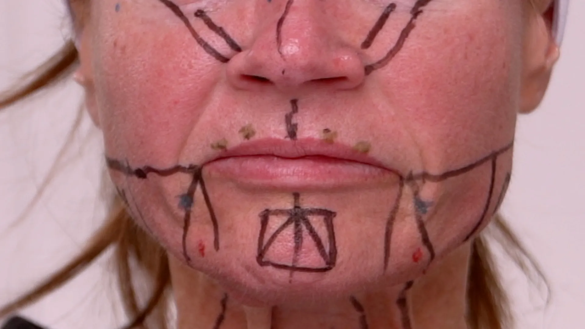 Face & Neck Map 200-UnitS Of Korean Toxin Dehantox - treatment image