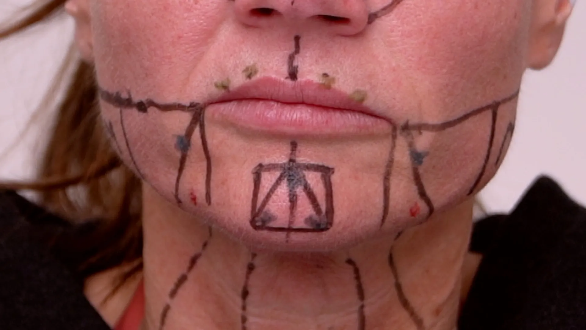 Face & Neck Map 200-UnitS Of Korean Toxin Dehantox - treatment image