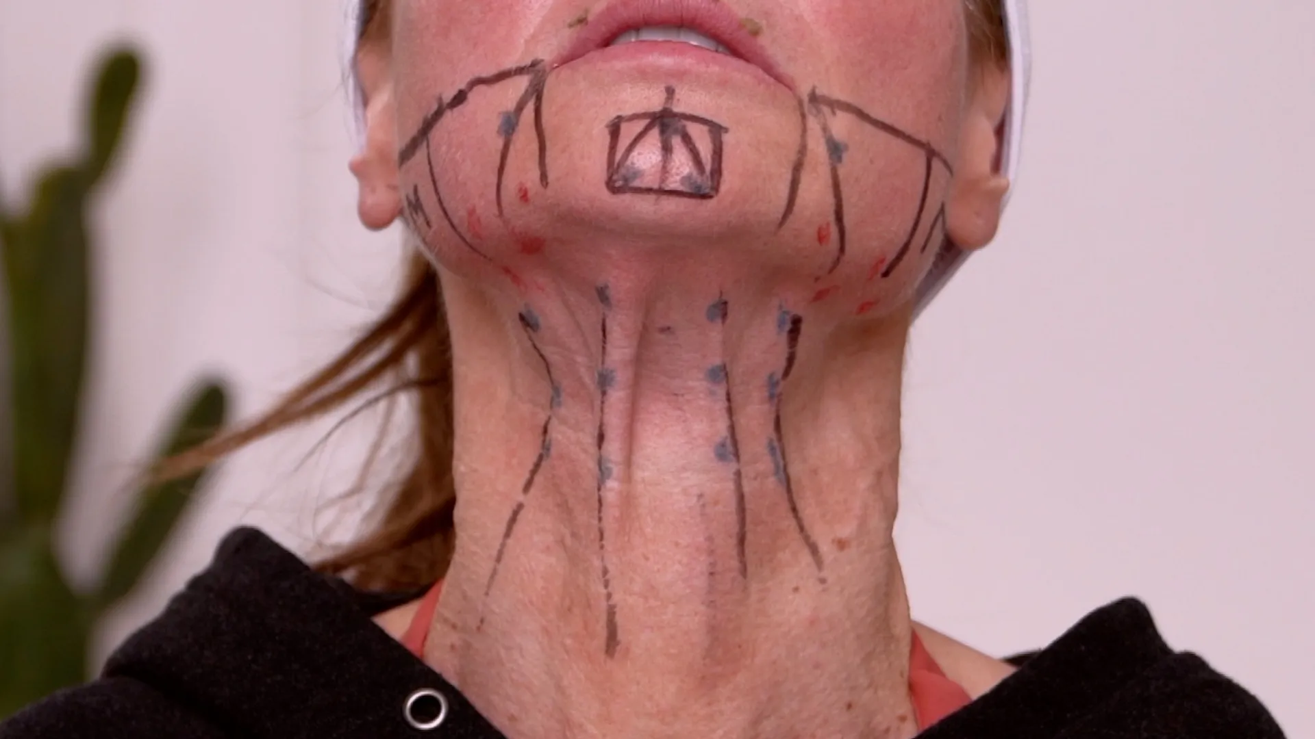 Face & Neck Map 200-UnitS Of Korean Toxin Dehantox - treatment image