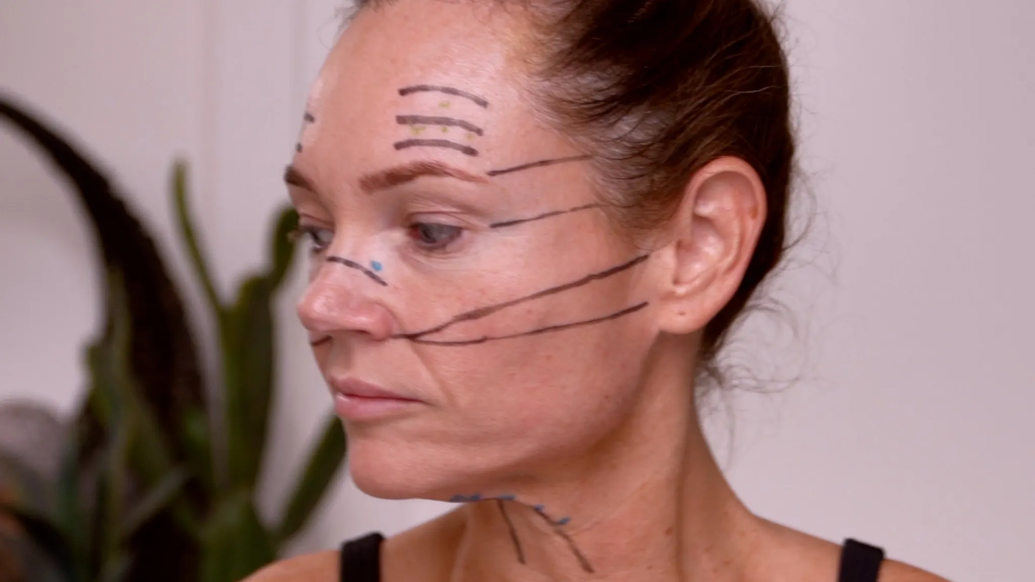 Dehantox 100U Mapping Update: Best Practices for Touch-Up Treatments - treatment image