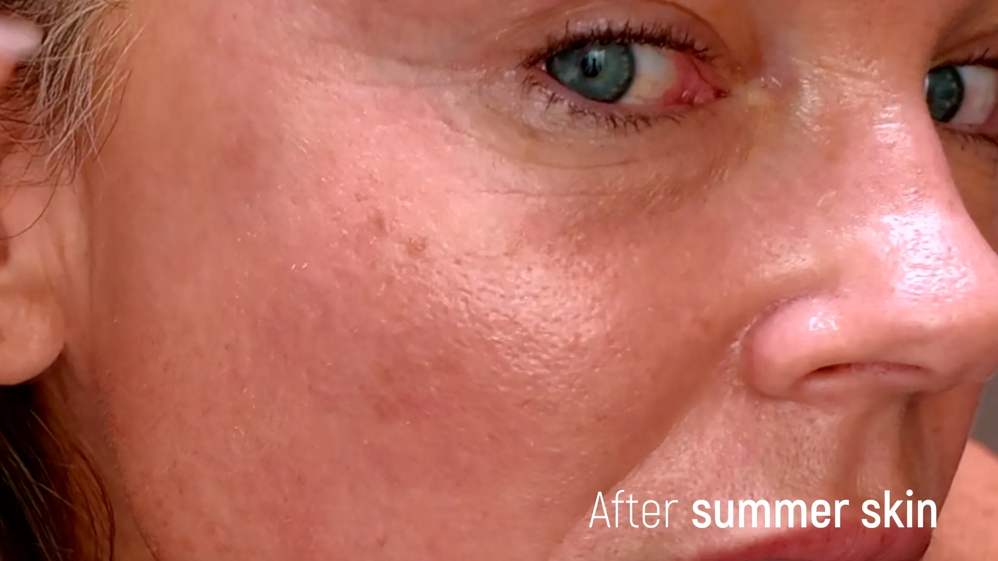 30% TCA Chemical Peel — What No One Shows - treatment image