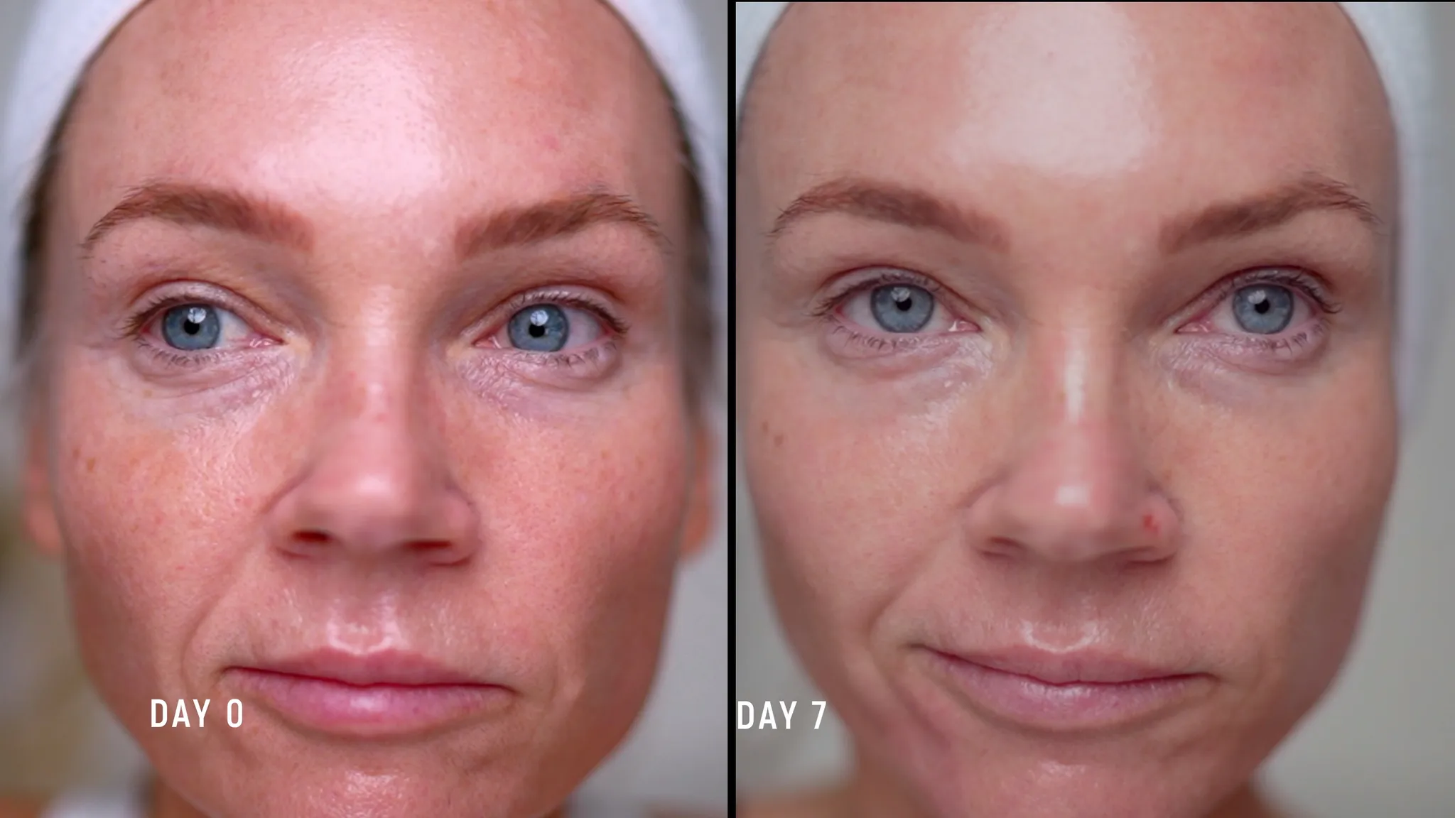 30% TCA Chemical Peel — What No One Shows - treatment image