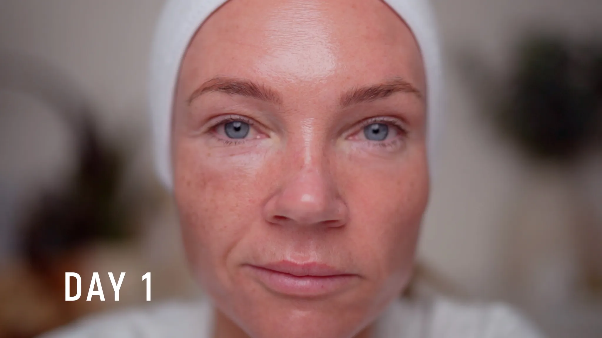 30% TCA Chemical Peel — What No One Shows - treatment image