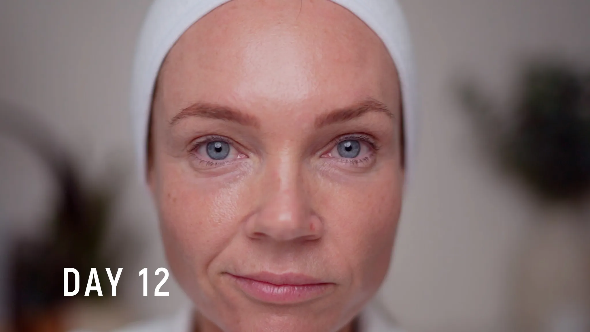 30% TCA Chemical Peel — What No One Shows - treatment image