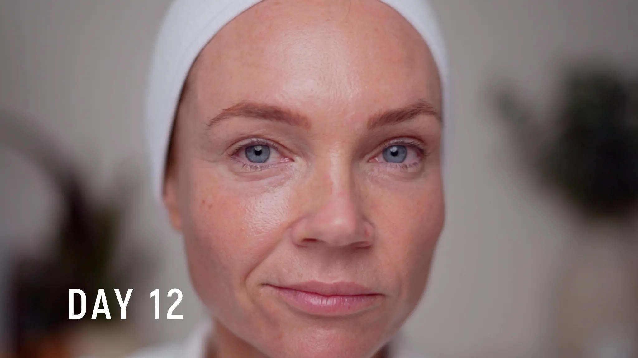30% TCA Chemical Peel — What No One Shows - treatment image