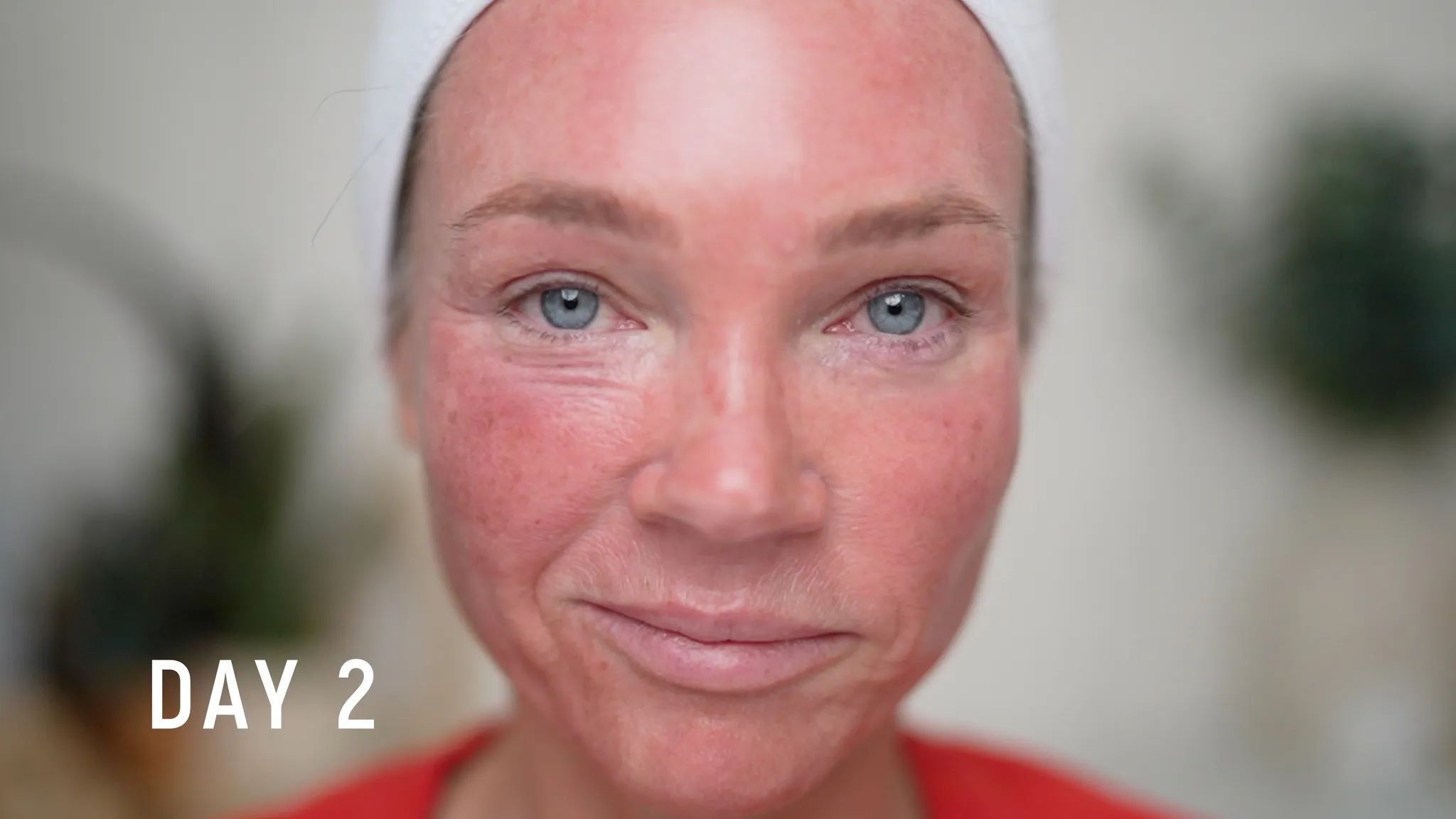 30% TCA Chemical Peel — What No One Shows - treatment image
