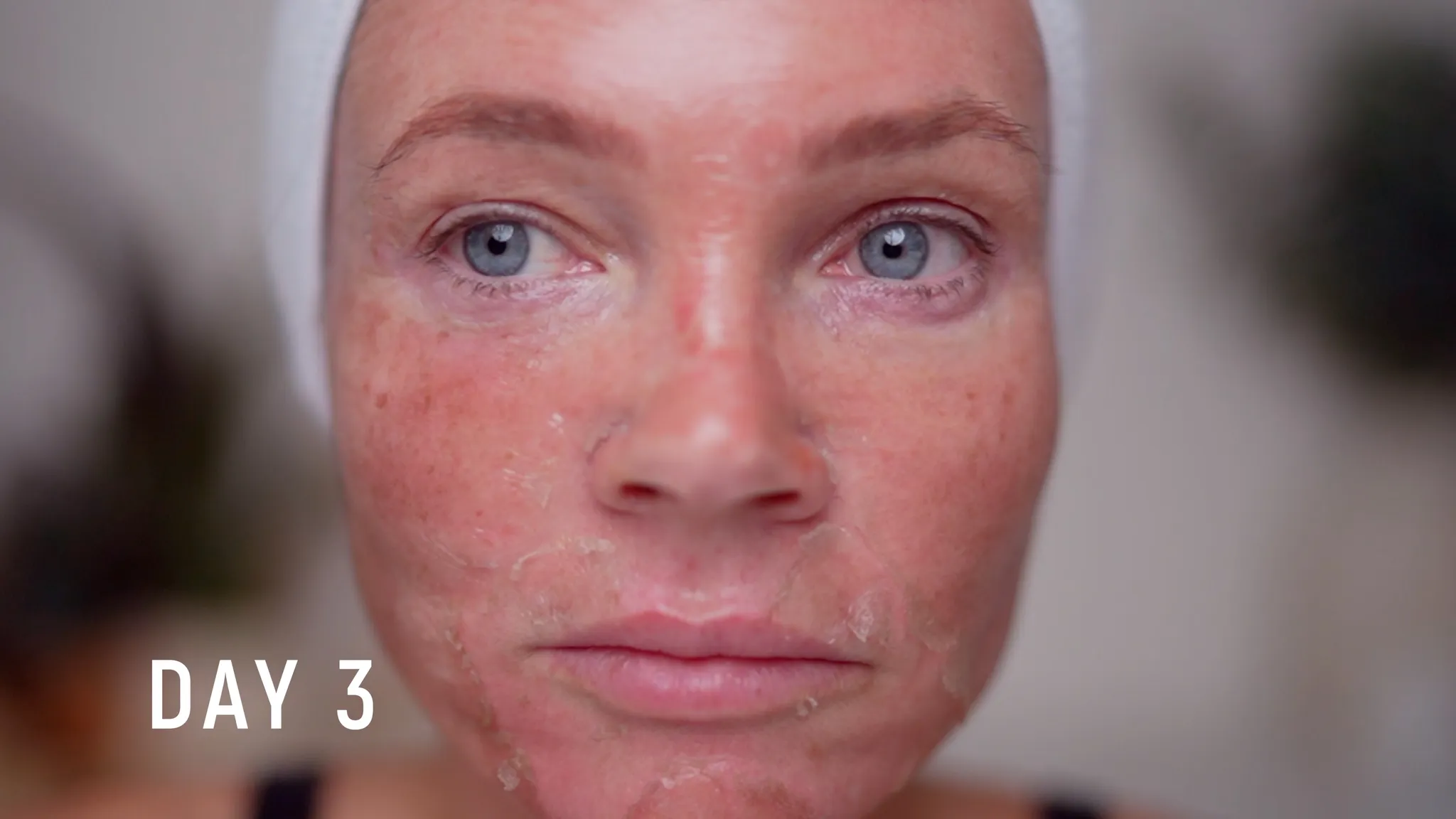30% TCA Chemical Peel — What No One Shows - treatment image