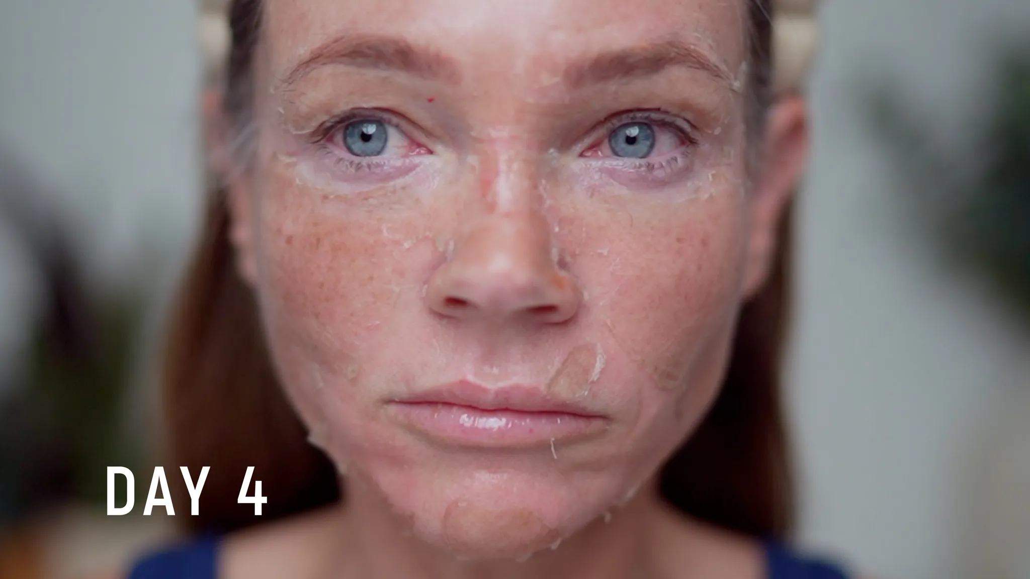 30% TCA Chemical Peel — What No One Shows - treatment image