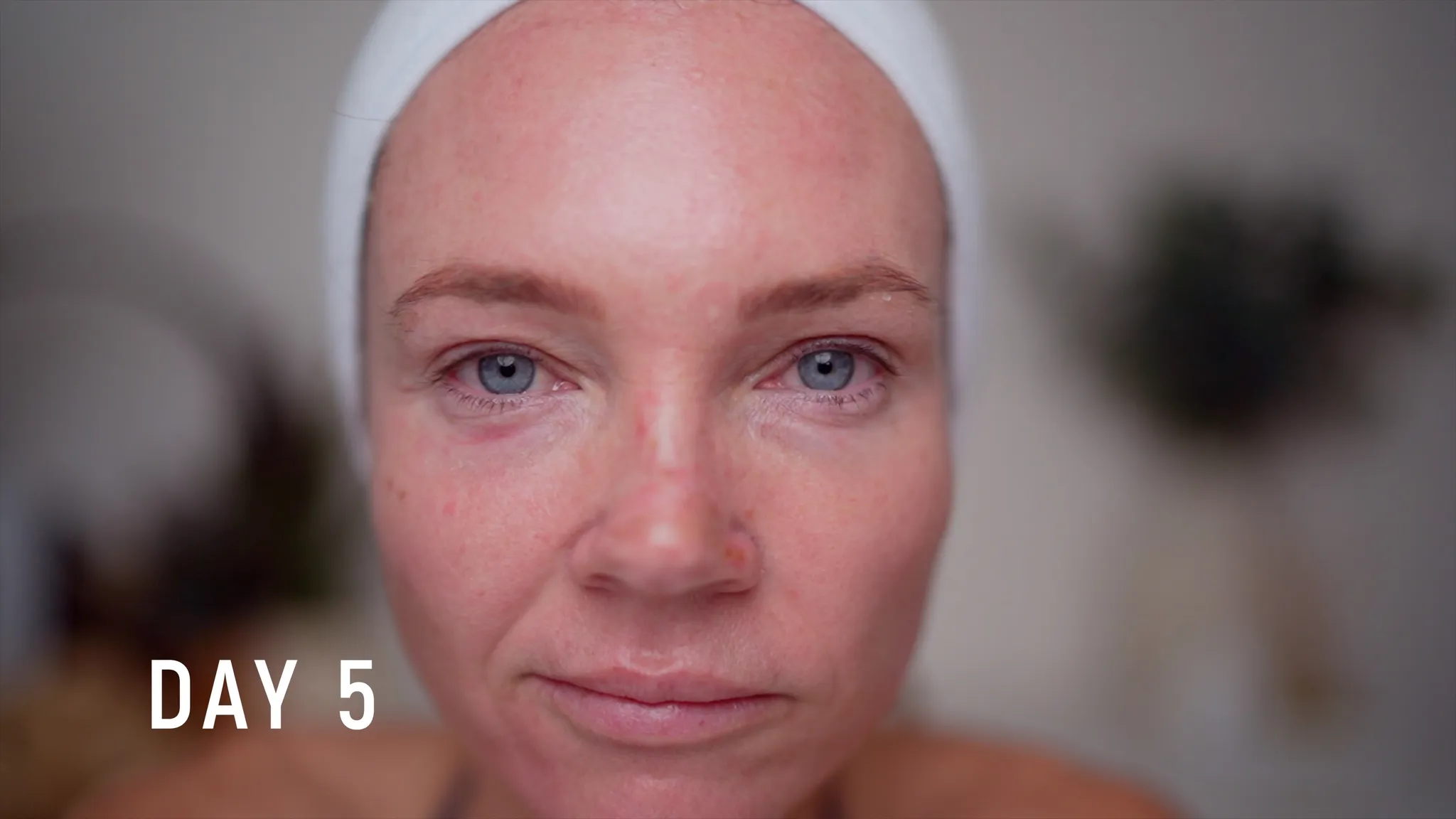 30% TCA Chemical Peel — What No One Shows - treatment image