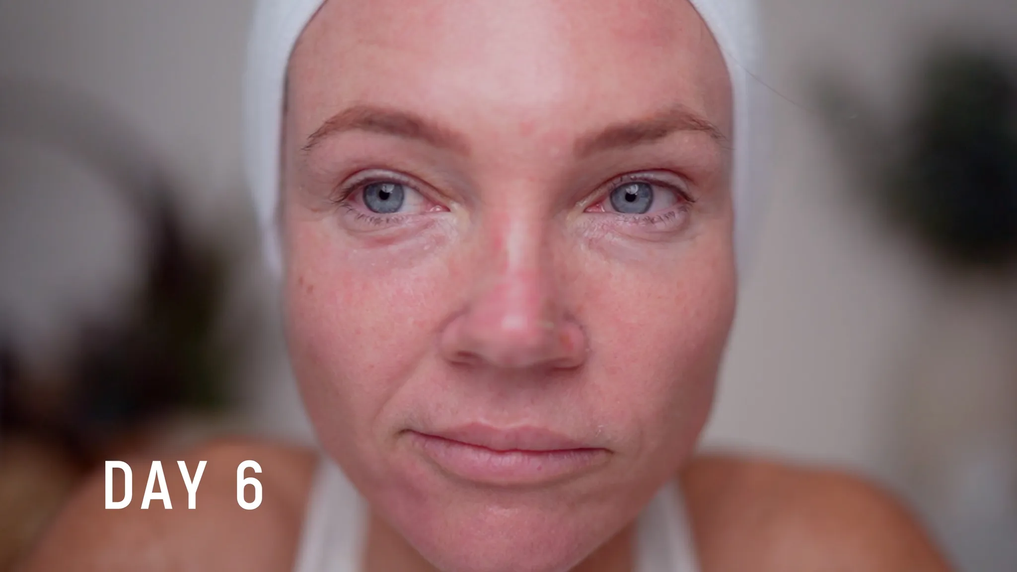 30% TCA Chemical Peel — What No One Shows - treatment image
