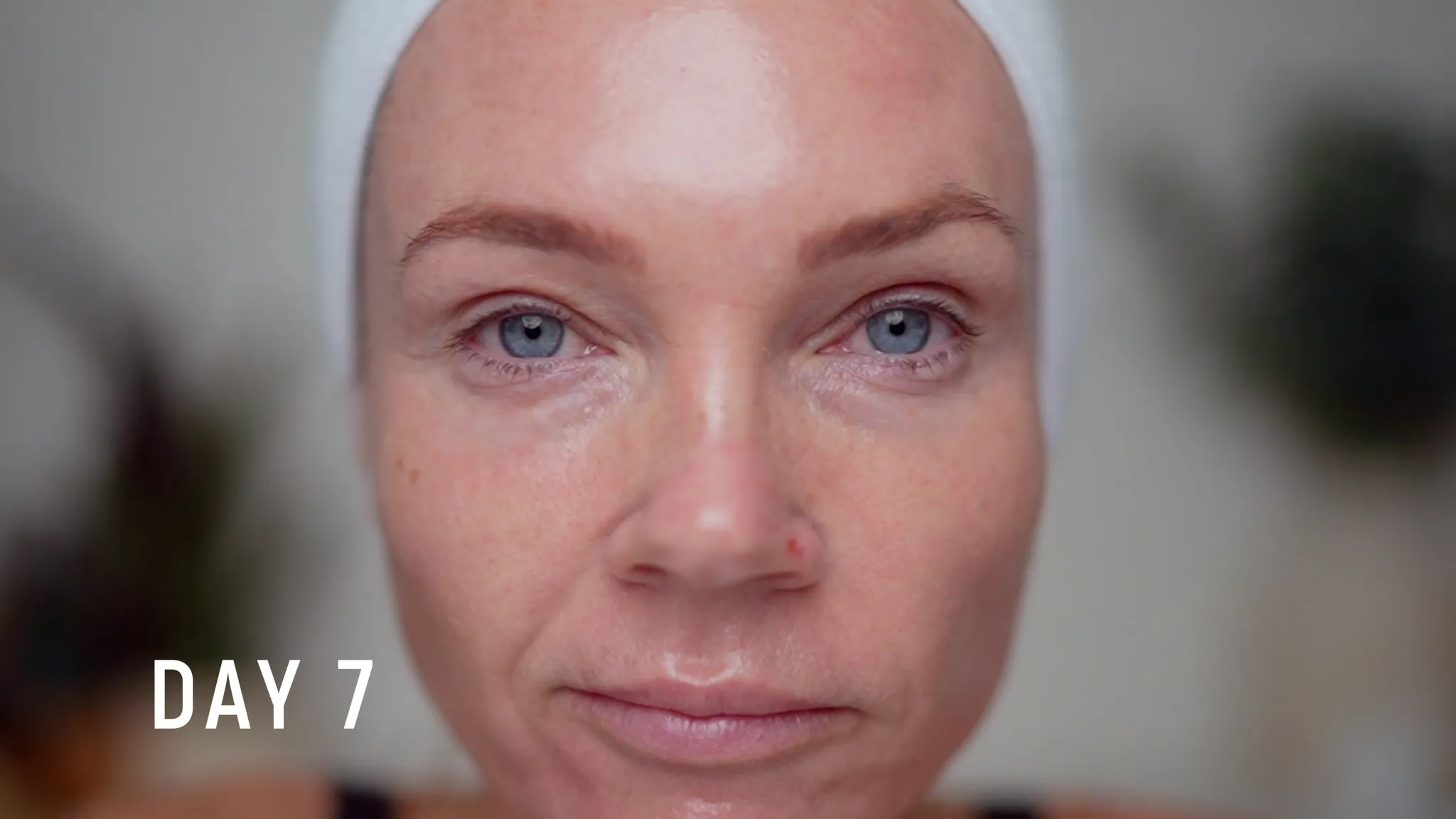 30% TCA Chemical Peel — What No One Shows - treatment image