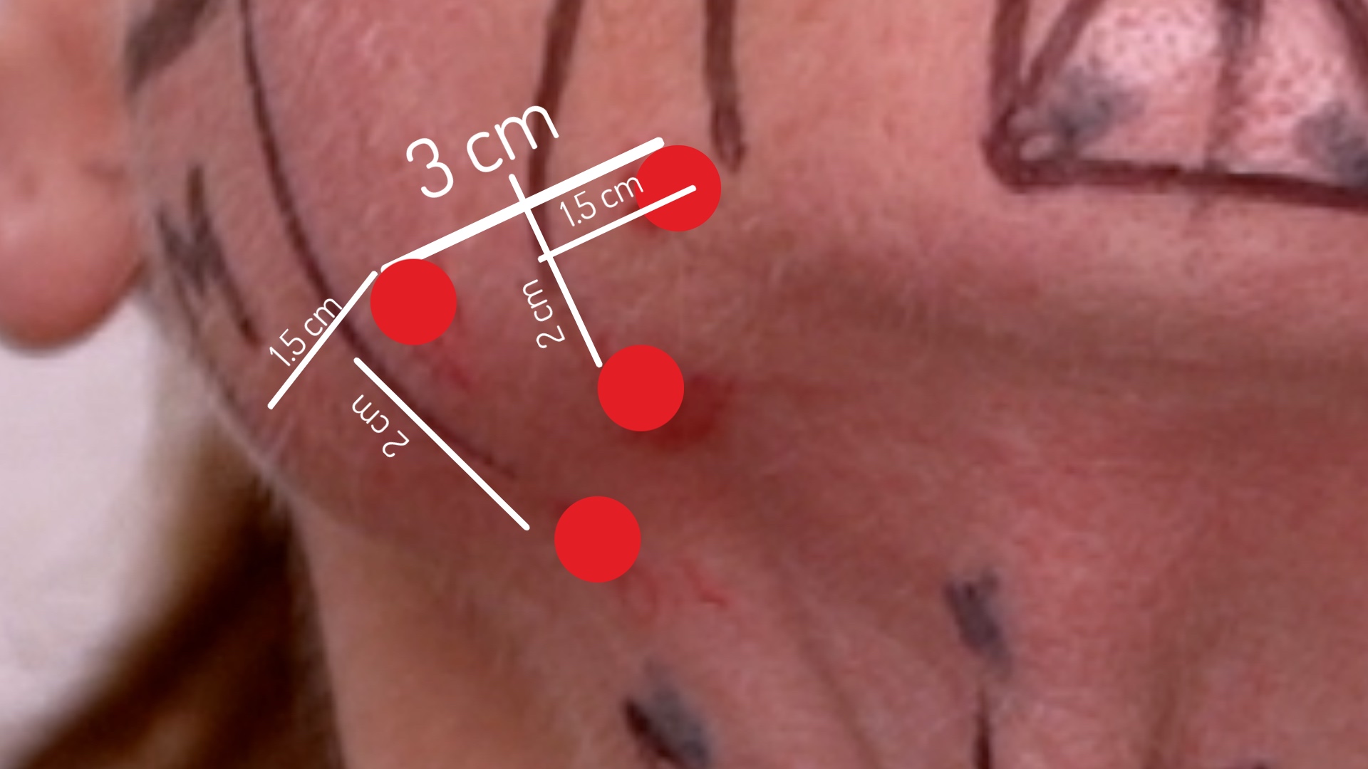 Face & Neck Map 200-UnitS Of Korean Toxin Dehantox - treatment image