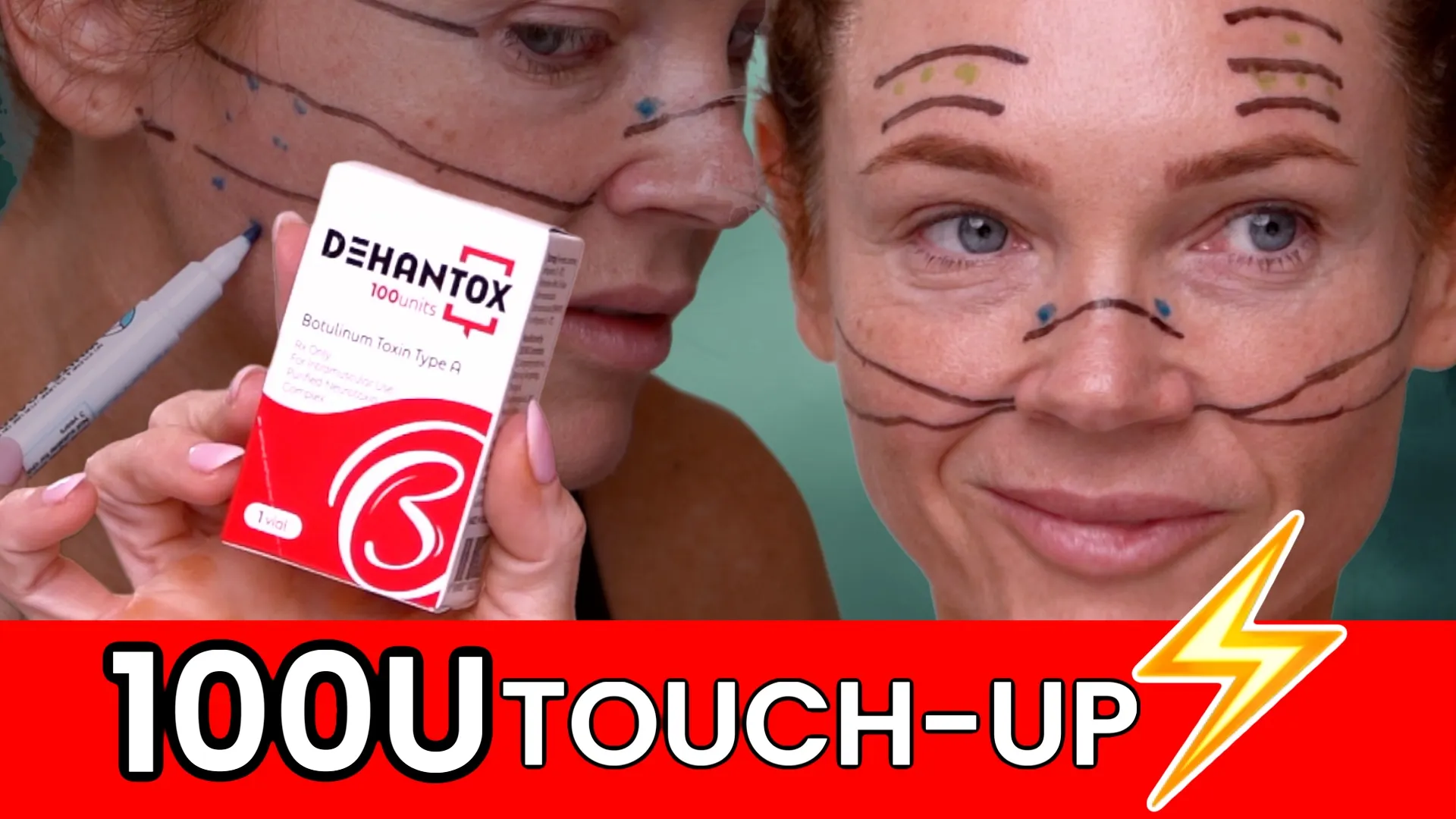 Dehantox 100U Mapping Update: Best Practices for Touch-Up Treatments