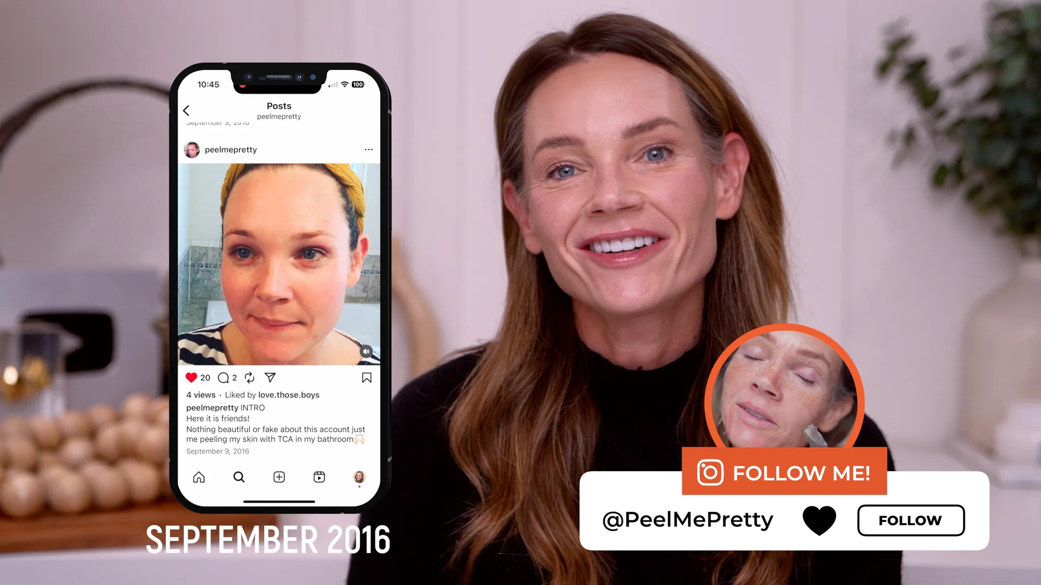 30% TCA Chemical Peel — What No One Shows - treatment image