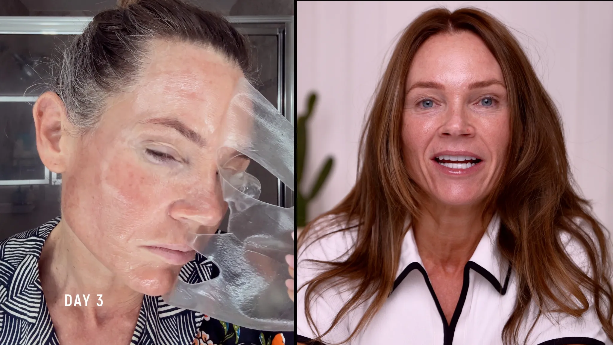 30% TCA Chemical Peel — What No One Shows - treatment image
