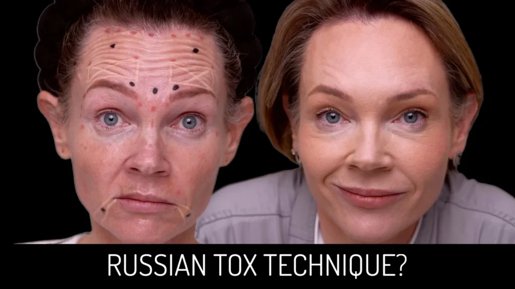 Russian Toxin Injection For A Lifted Look