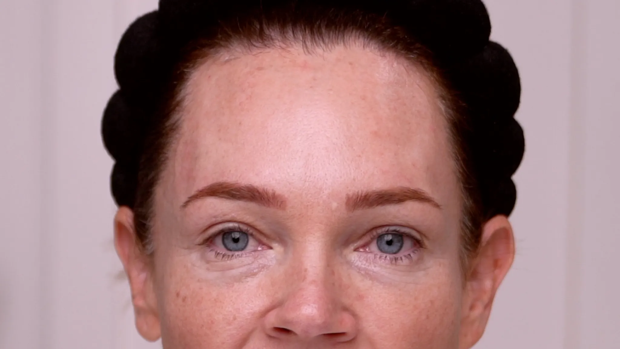 Dehantox 100U Mapping Update: Best Practices for Touch-Up Treatments - treatment image