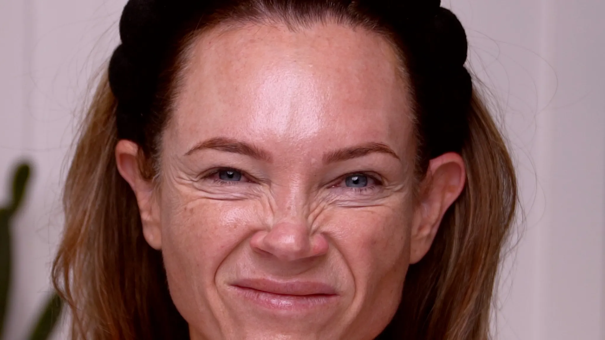 Dehantox 100U Mapping Update: Best Practices for Touch-Up Treatments - treatment image
