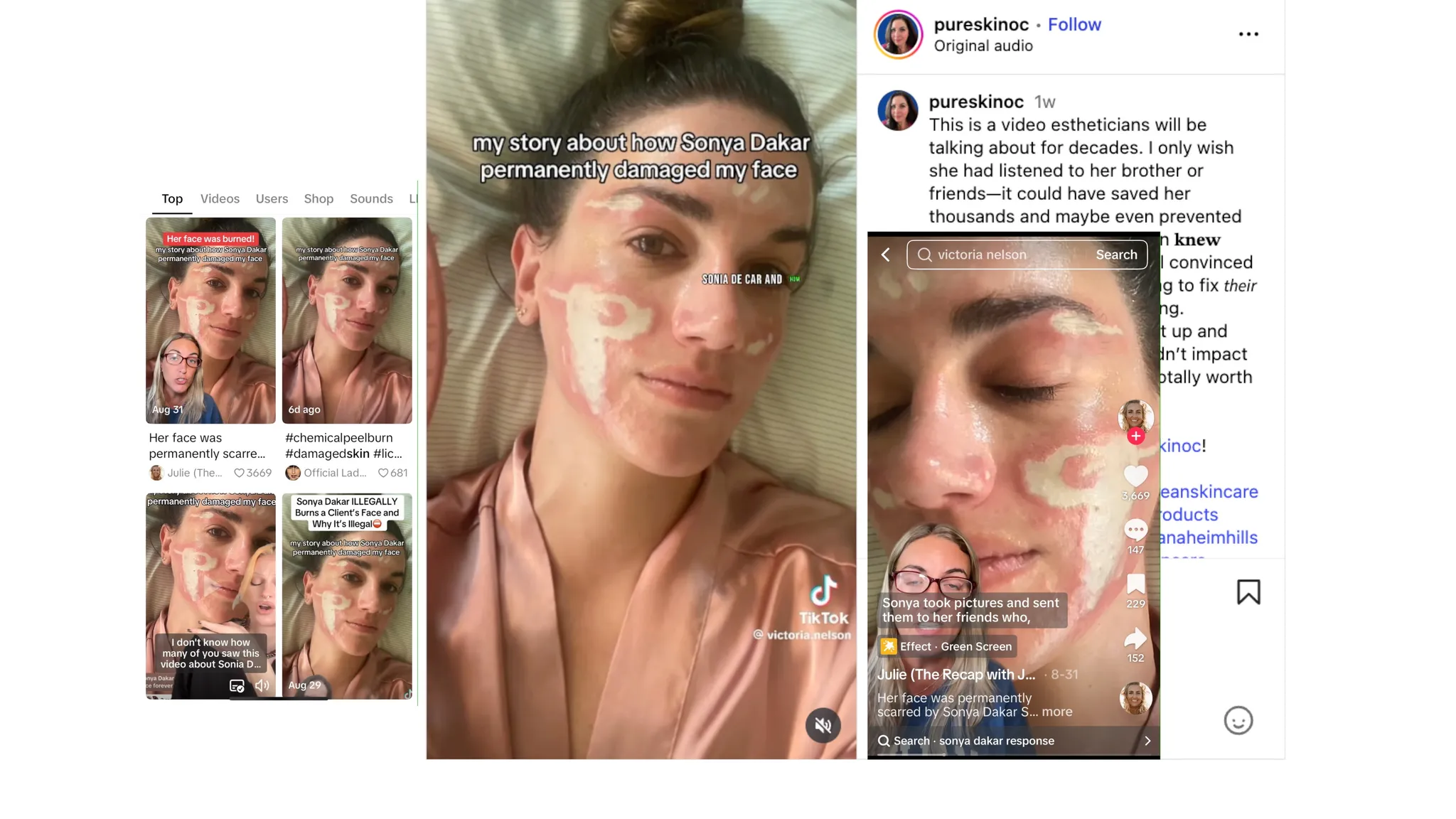 30% TCA Chemical Peel — What No One Shows - treatment image