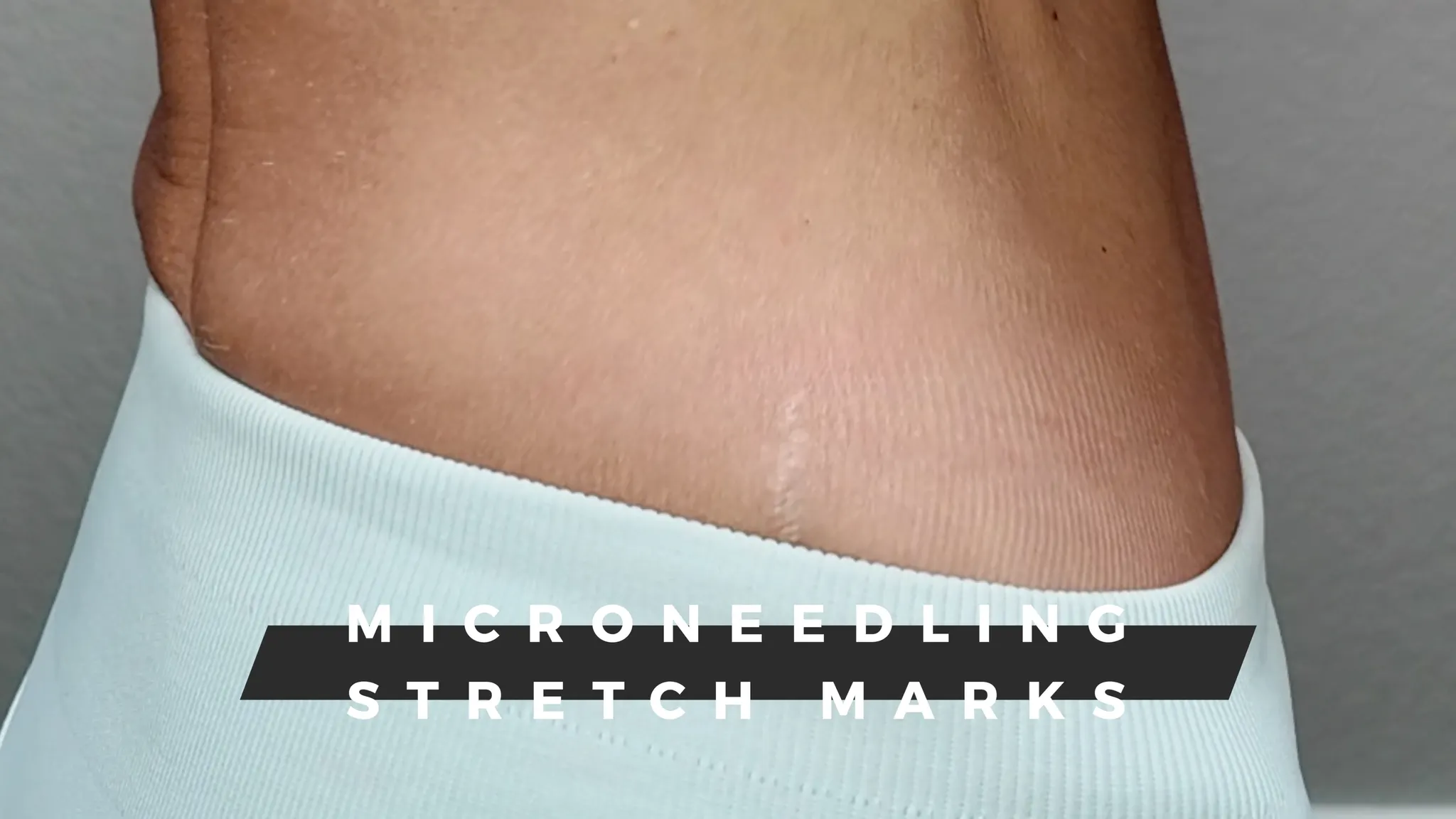 Microneedling Stretch Marks with Results