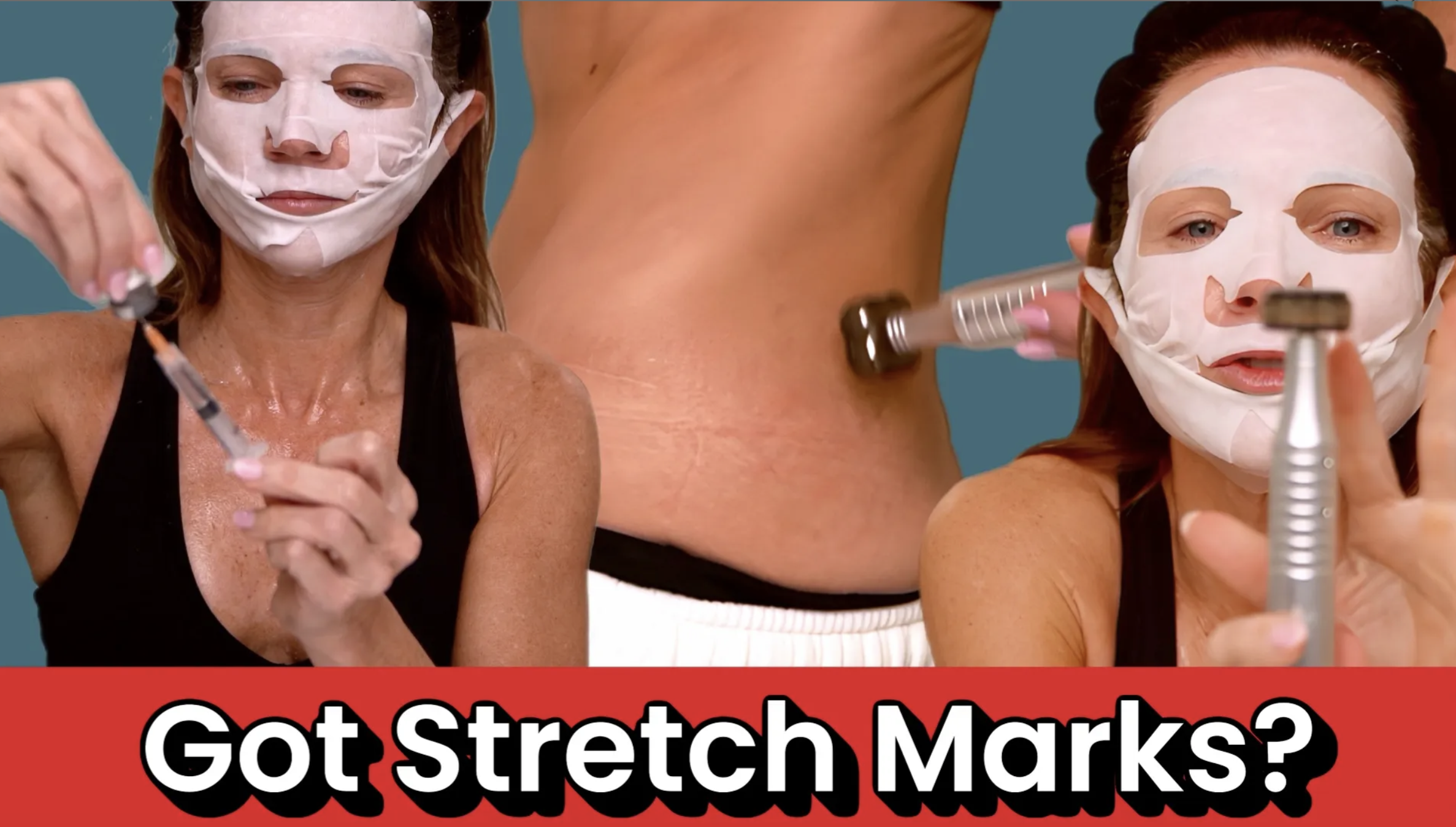 Microneedling Stretch Marks with Results