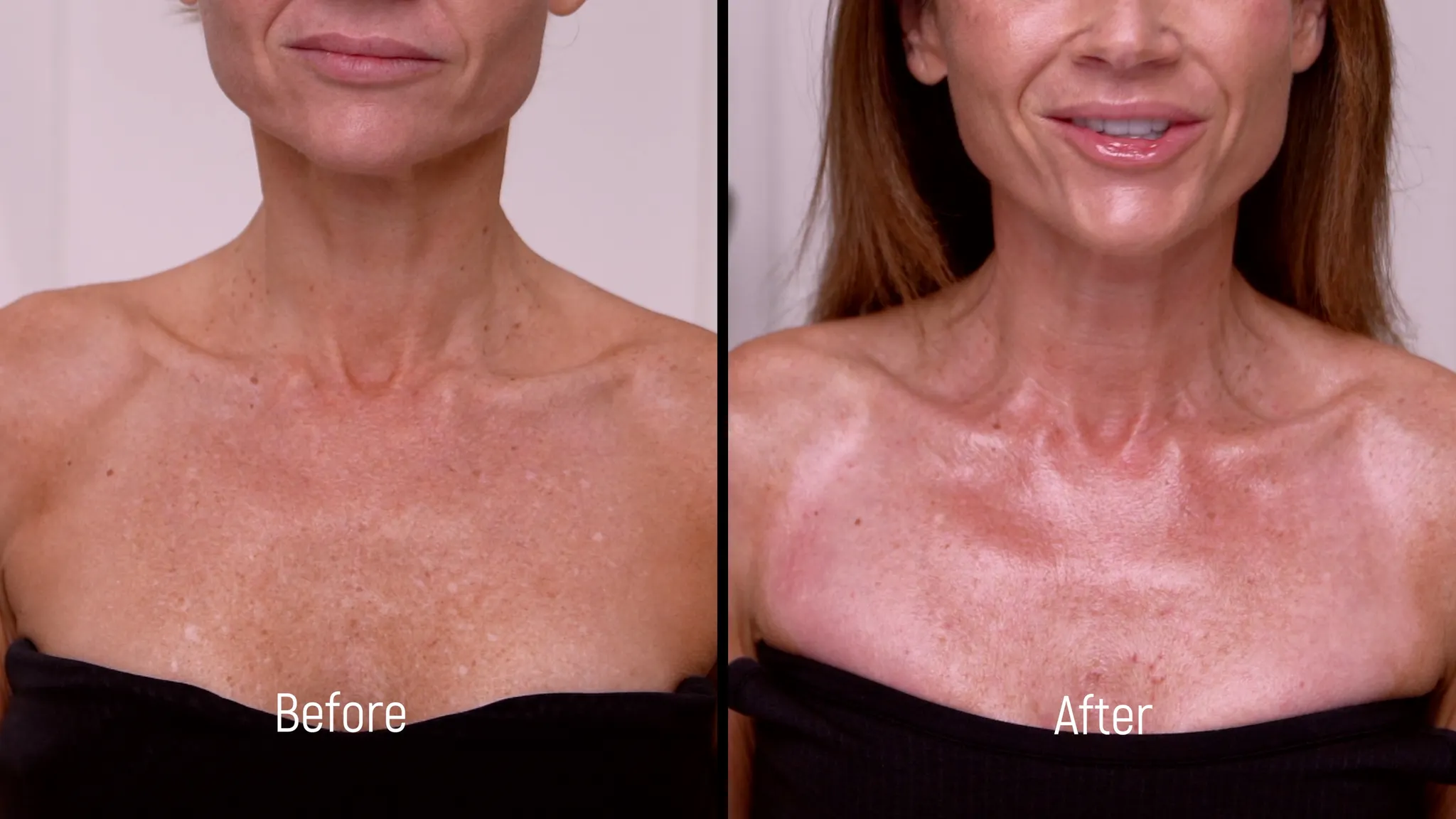 20% TCA Peel Neck & Chest Results and Safety Guide