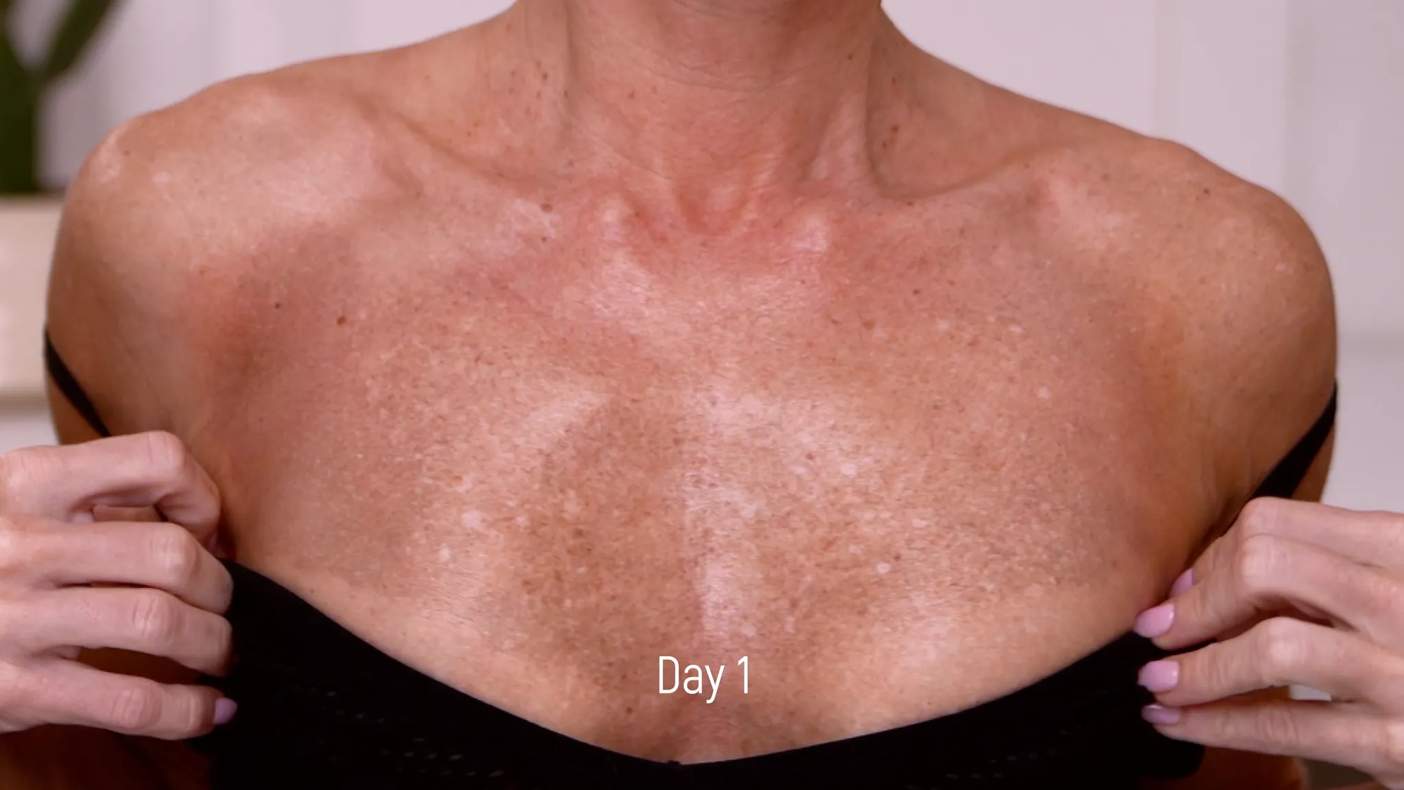 20% TCA Peel Neck & Chest Results and Safety Guide - treatment image