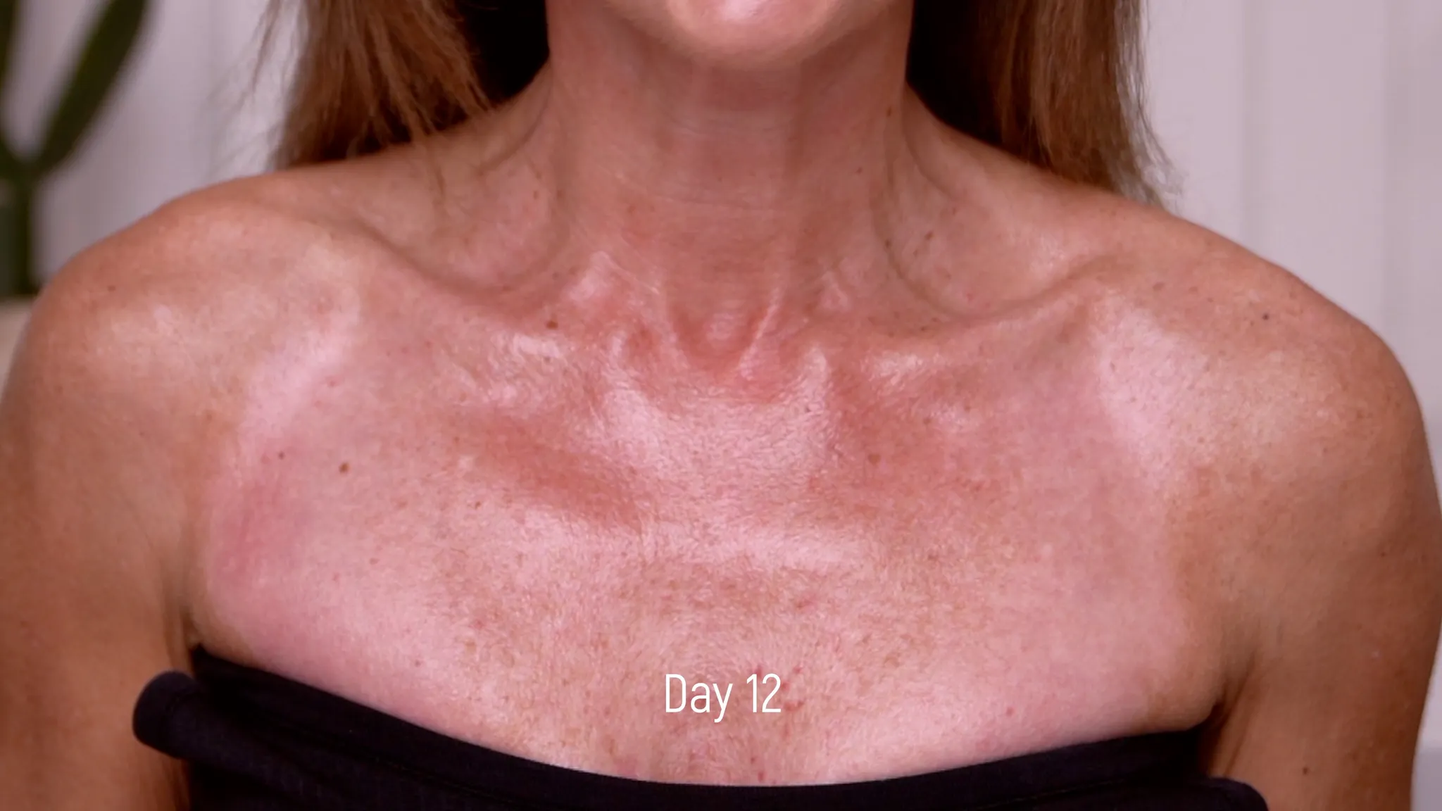 20% TCA Peel Neck & Chest Results and Safety Guide - treatment image