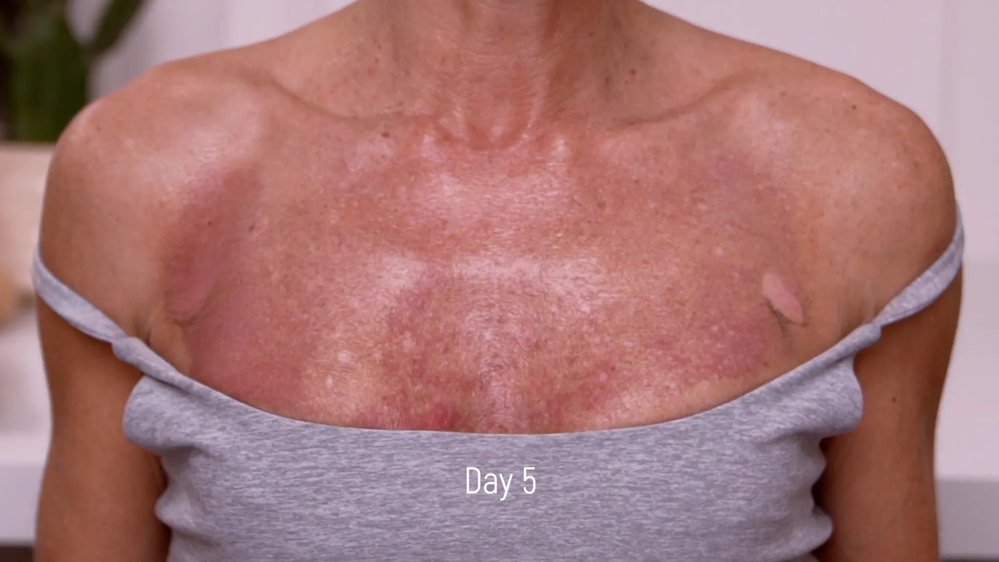 20% TCA Peel Neck & Chest Results and Safety Guide - treatment image