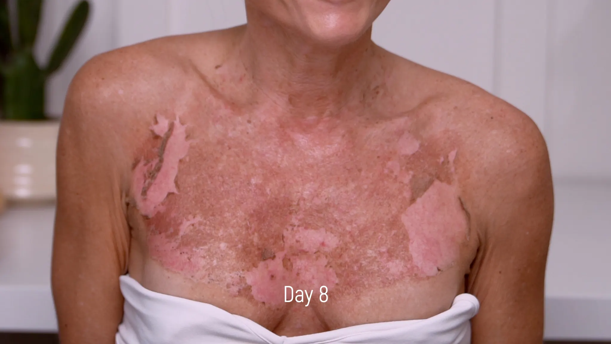 20% TCA Peel Neck & Chest Results and Safety Guide - treatment image