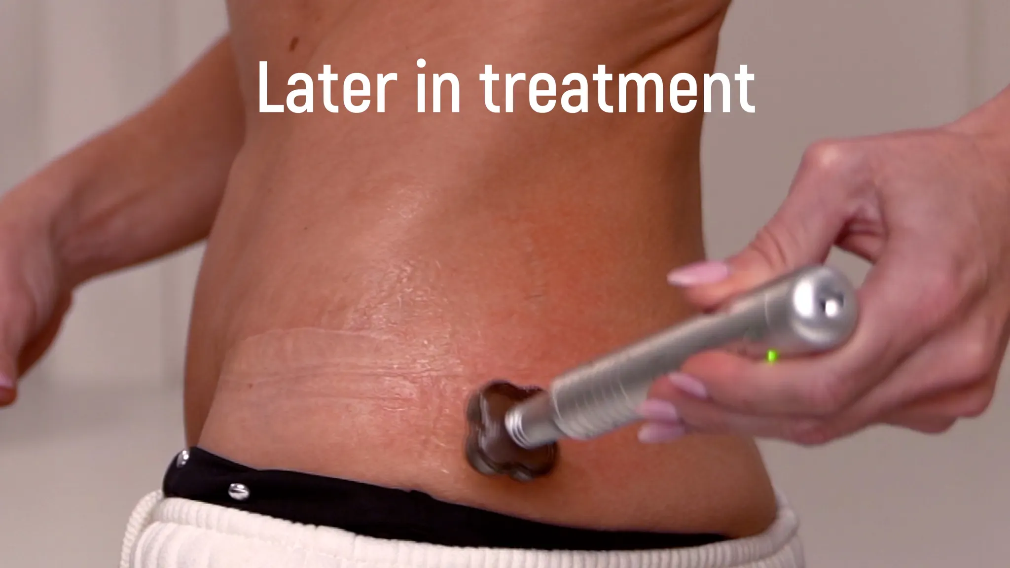 Microneedling Stretch Marks with Results - treatment image
