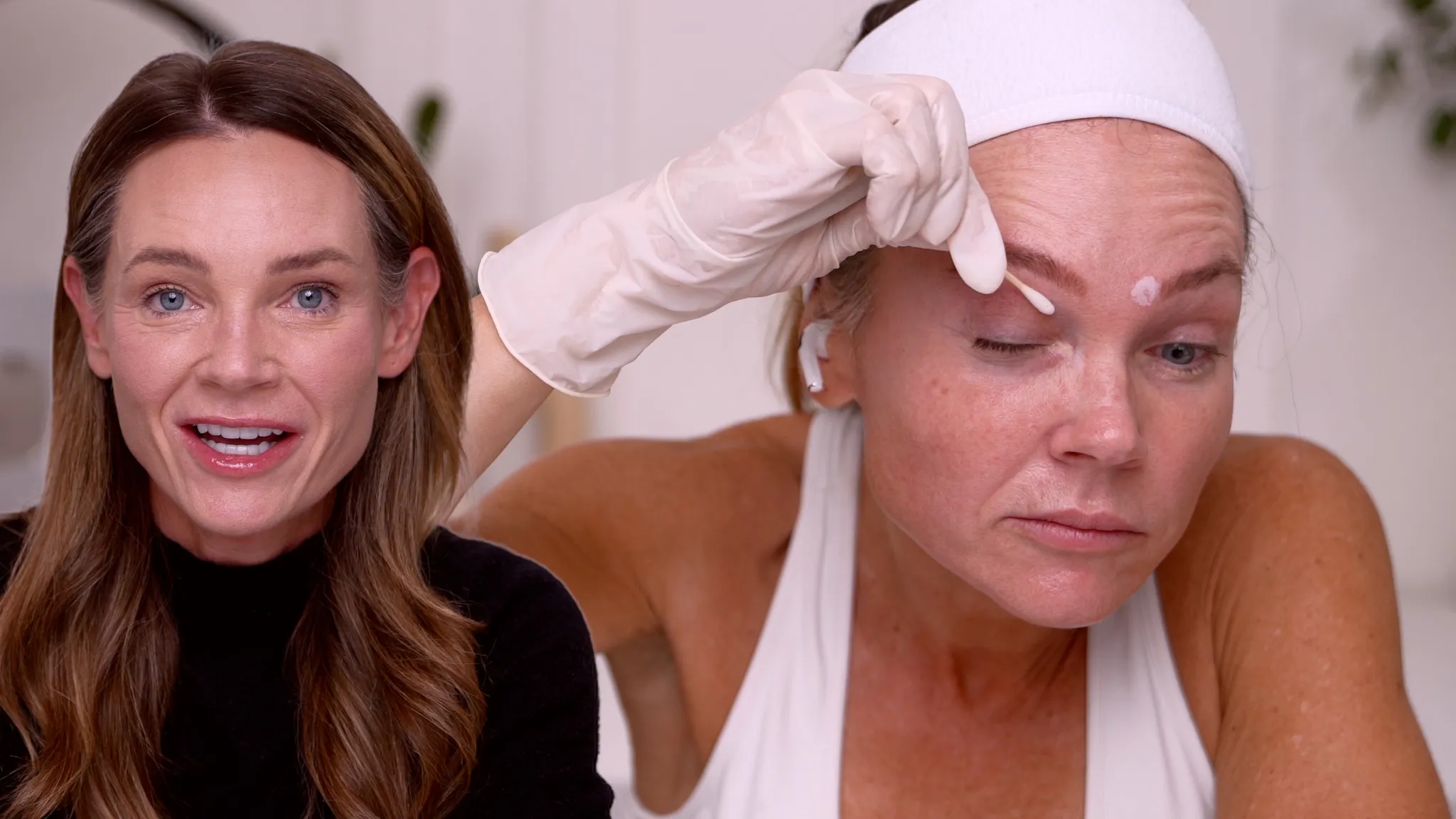 A 20% TCA Peel in 6 Days | Full Results - treatment image