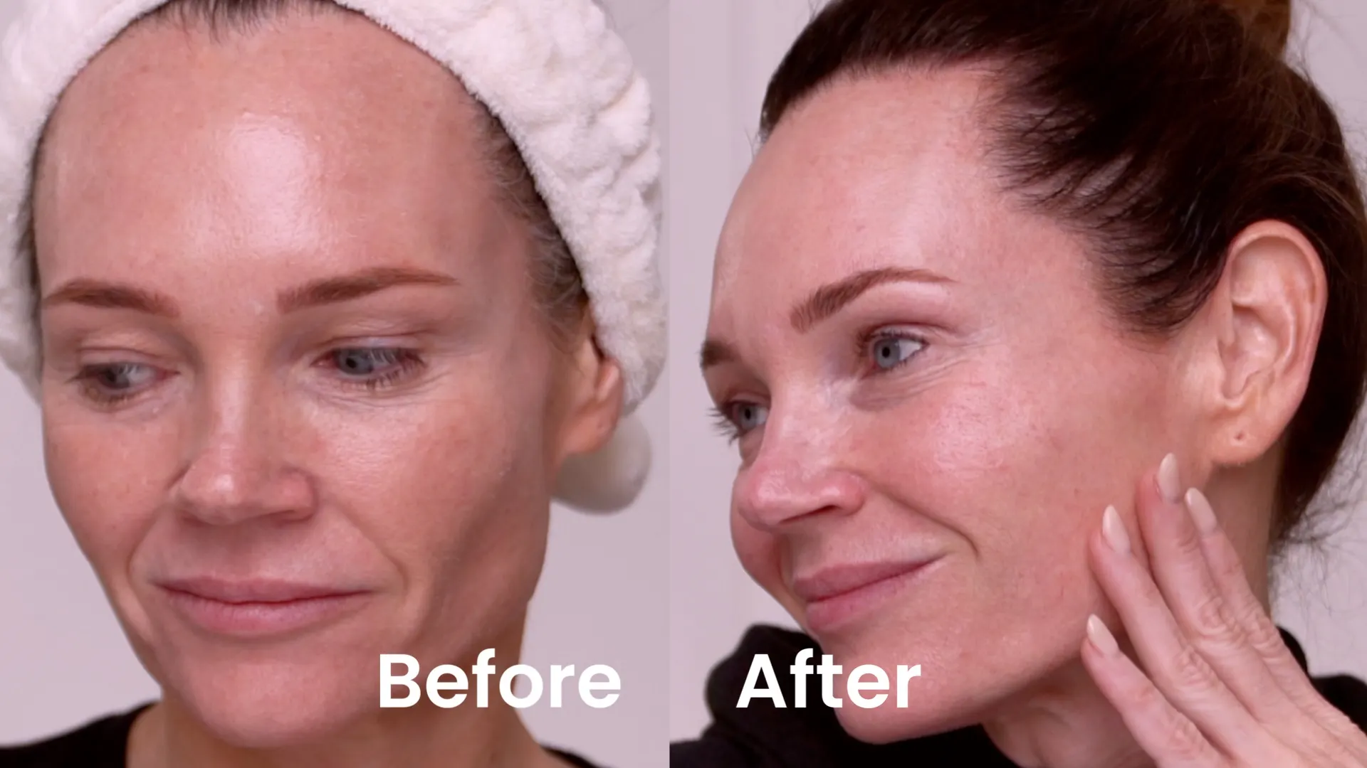 A 20% TCA Peel in 6 Days | Full Results