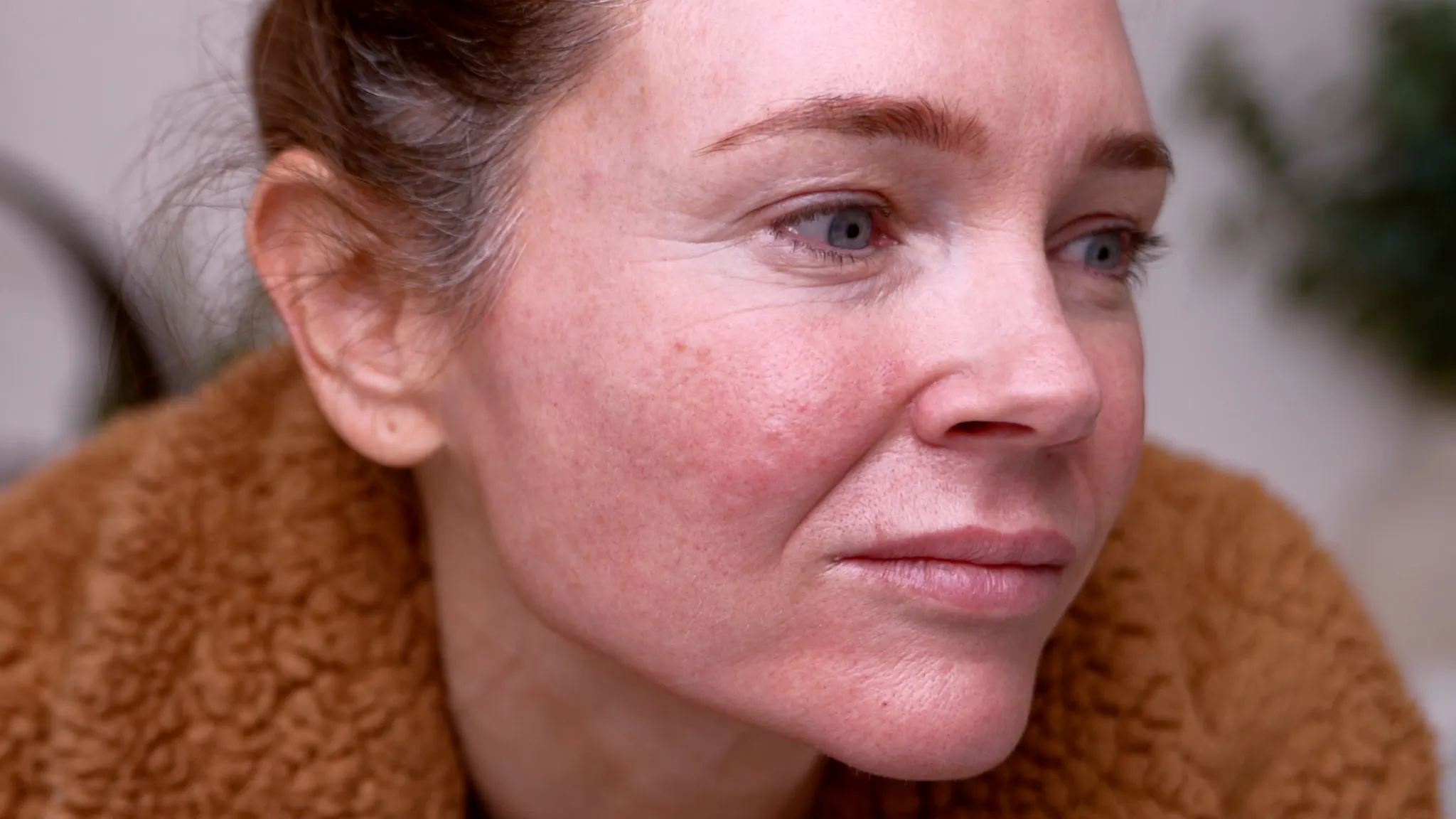 Microneedling With NAD+: What Happened When I Tested an NAD+ Complex on My Face - treatment image
