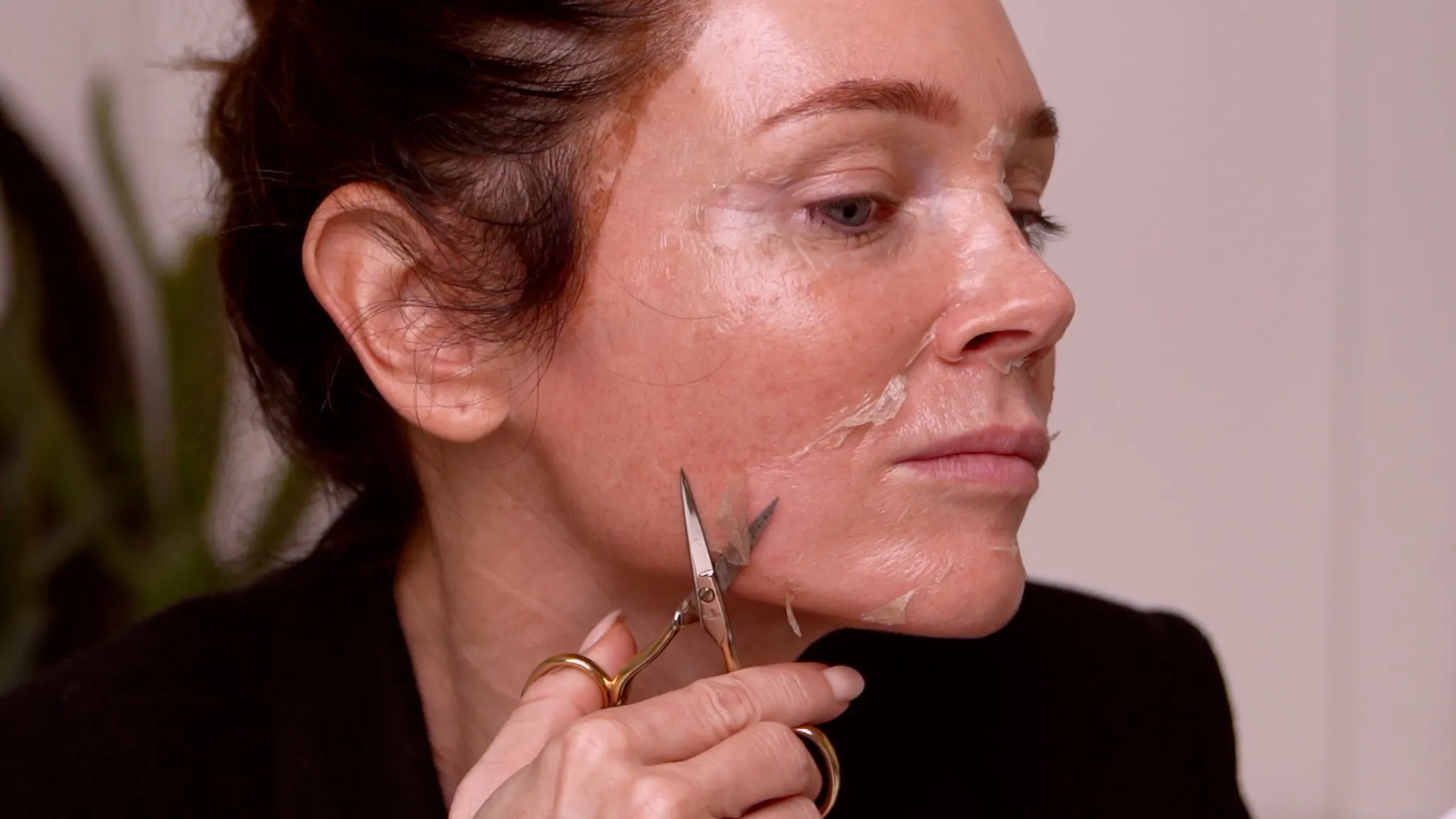 A 20% TCA Peel in 6 Days | Full Results - treatment image