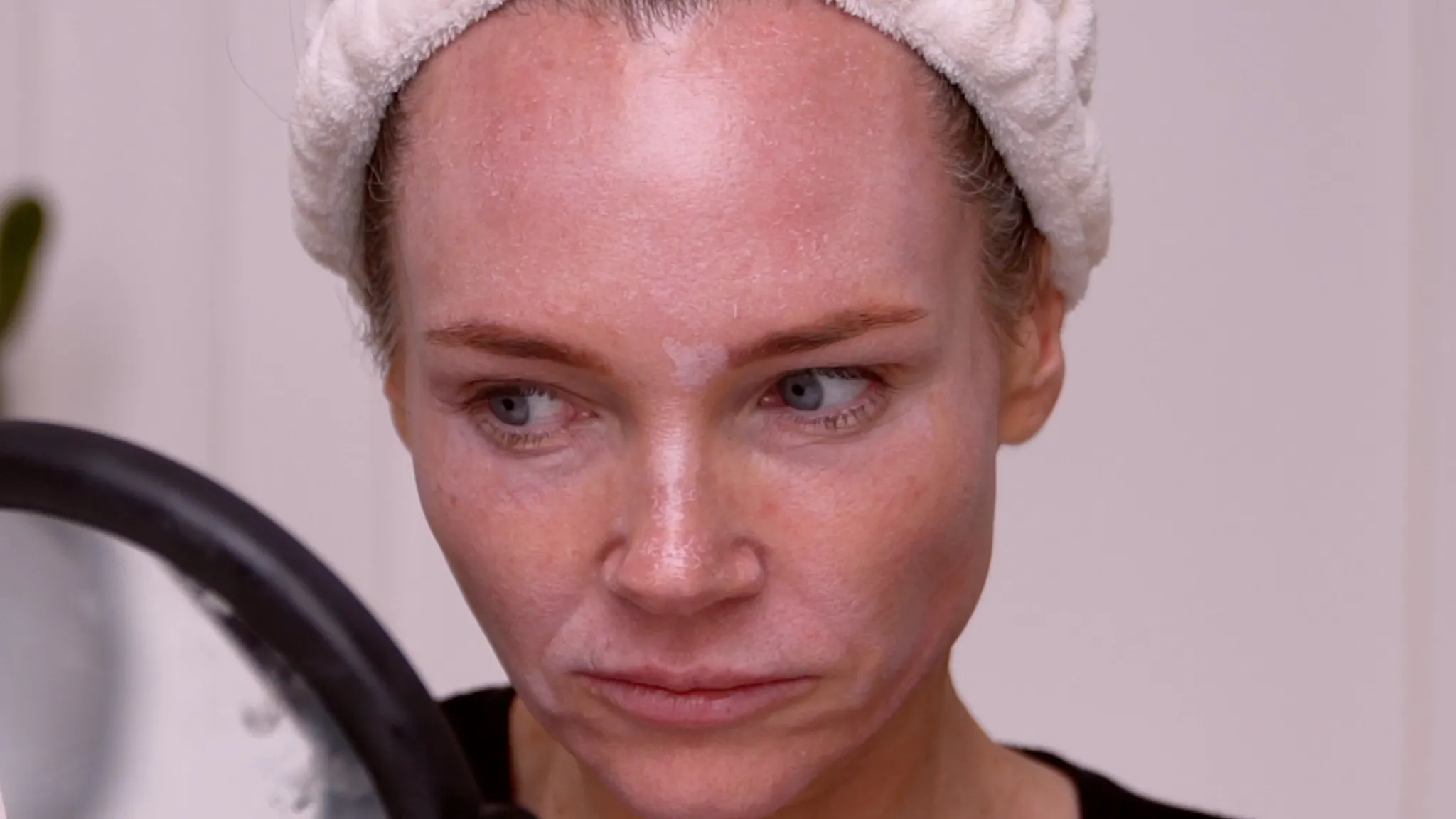 A 20% TCA Peel in 6 Days | Full Results - treatment image
