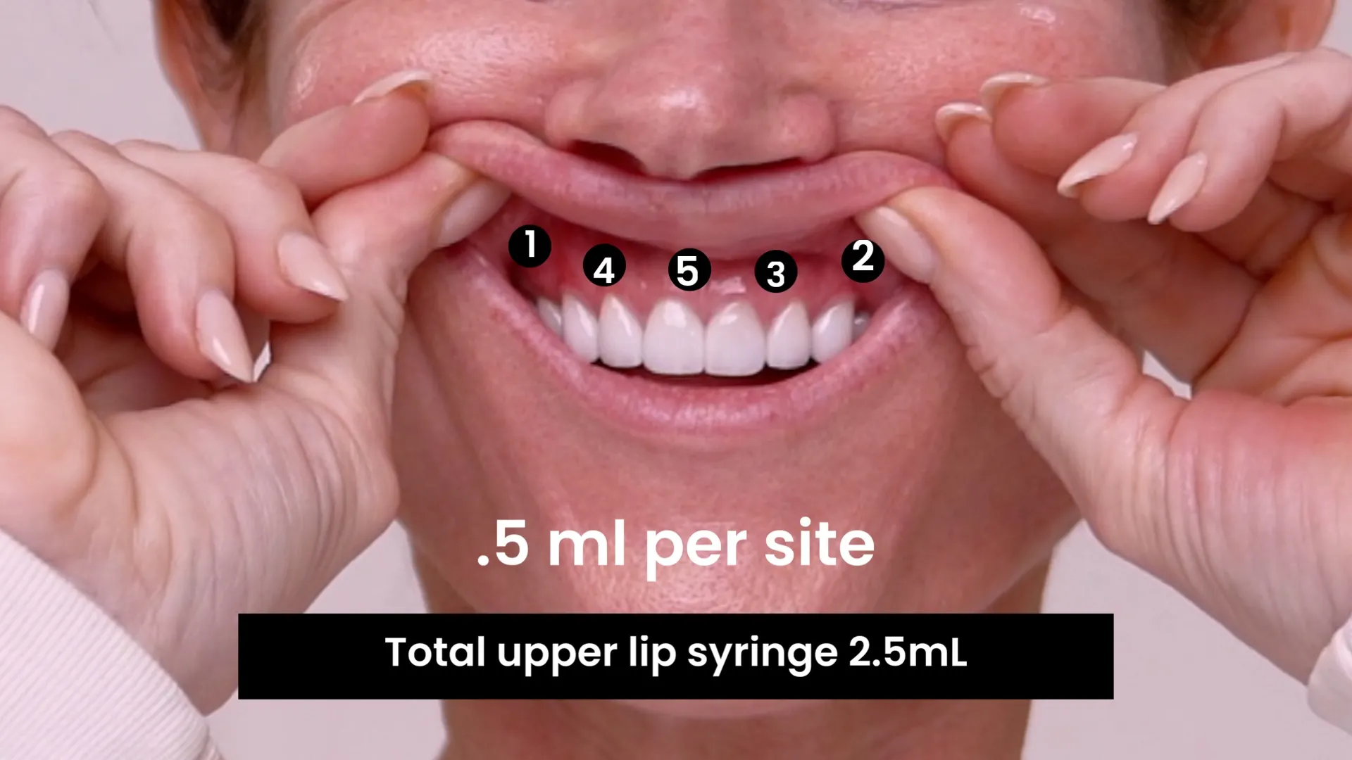 How to Do a Lip Ring Block With 2% Lidocaine (No Epi): Timing, Mapping, and Comfort Tips - treatment image