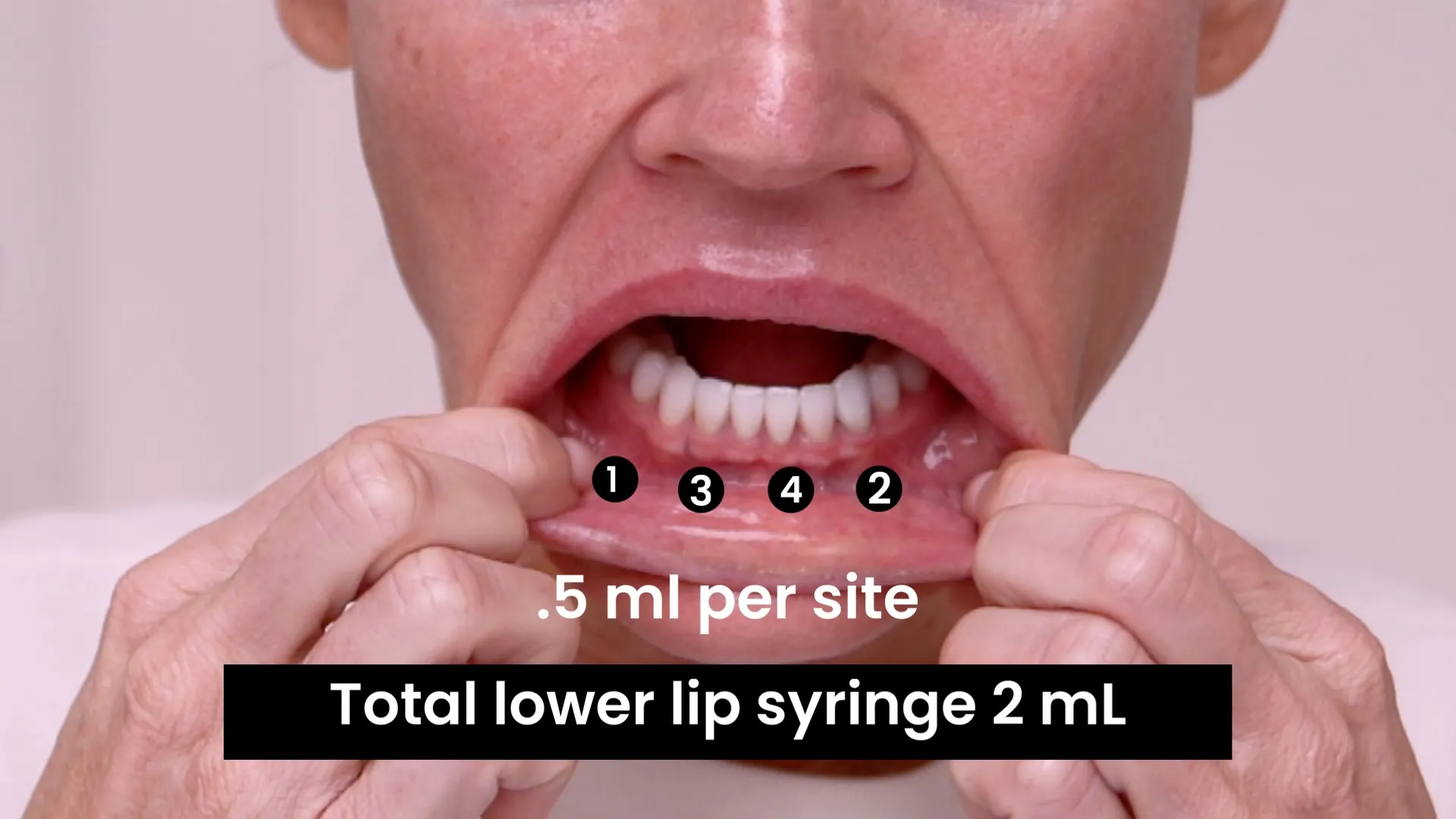 How to Do a Lip Ring Block With 2% Lidocaine (No Epi): Timing, Mapping, and Comfort Tips - treatment image