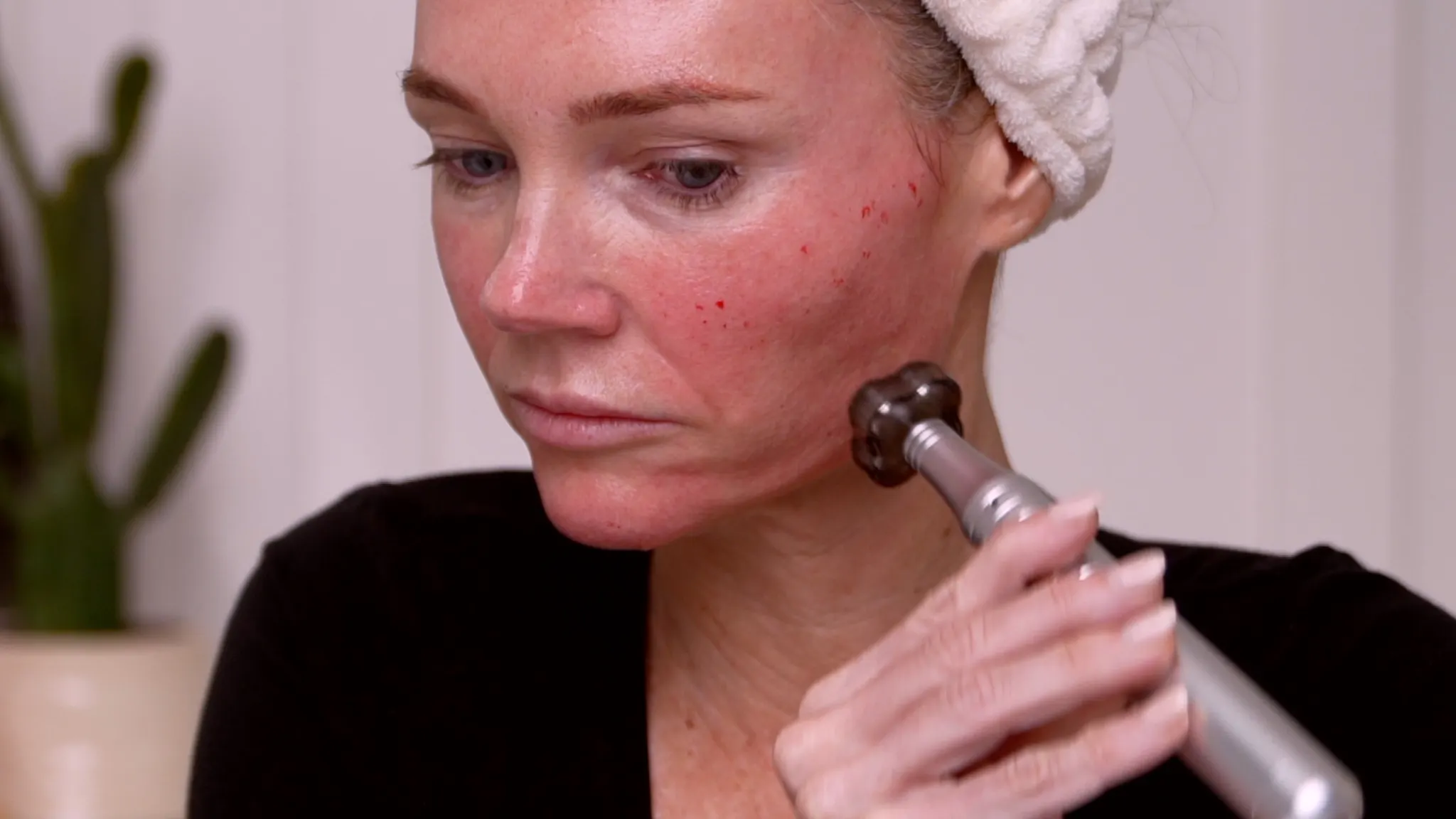 Microneedling With NAD+: What Happened When I Tested an NAD+ Complex on My Face - treatment image
