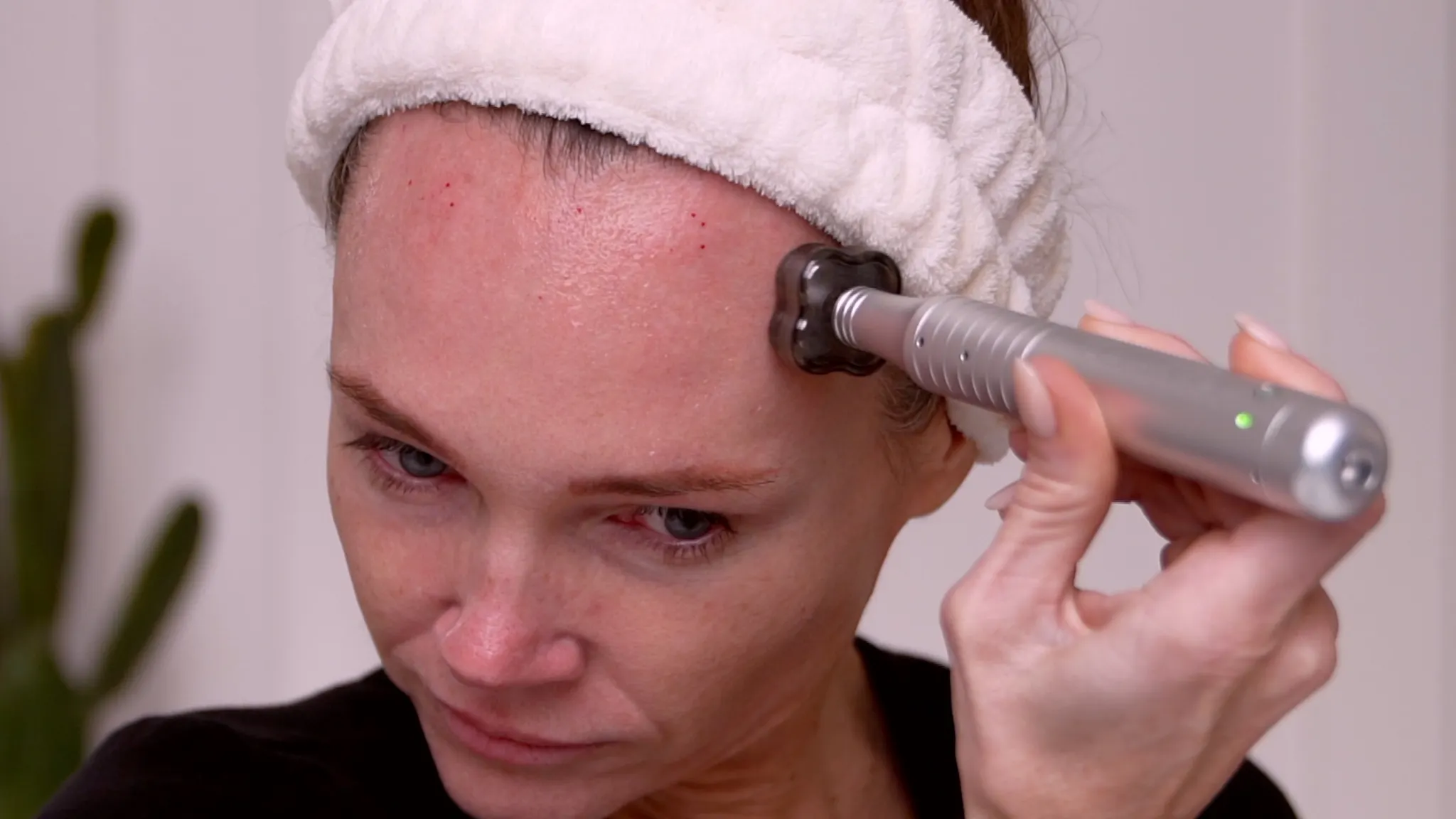 Microneedling With NAD+: What Happened When I Tested an NAD+ Complex on My Face - treatment image