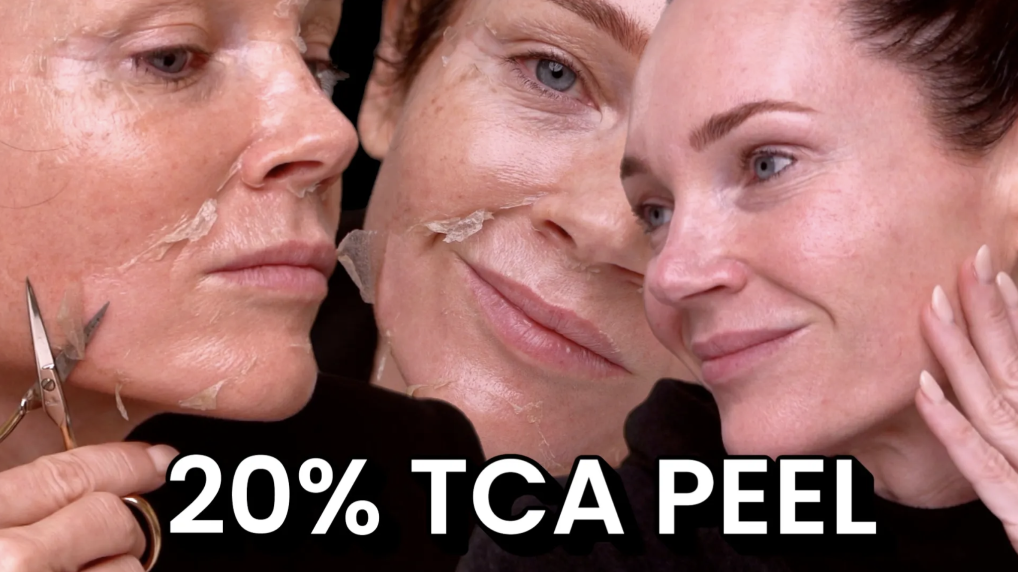 A 20% TCA Peel in 6 Days | Full Results - treatment image