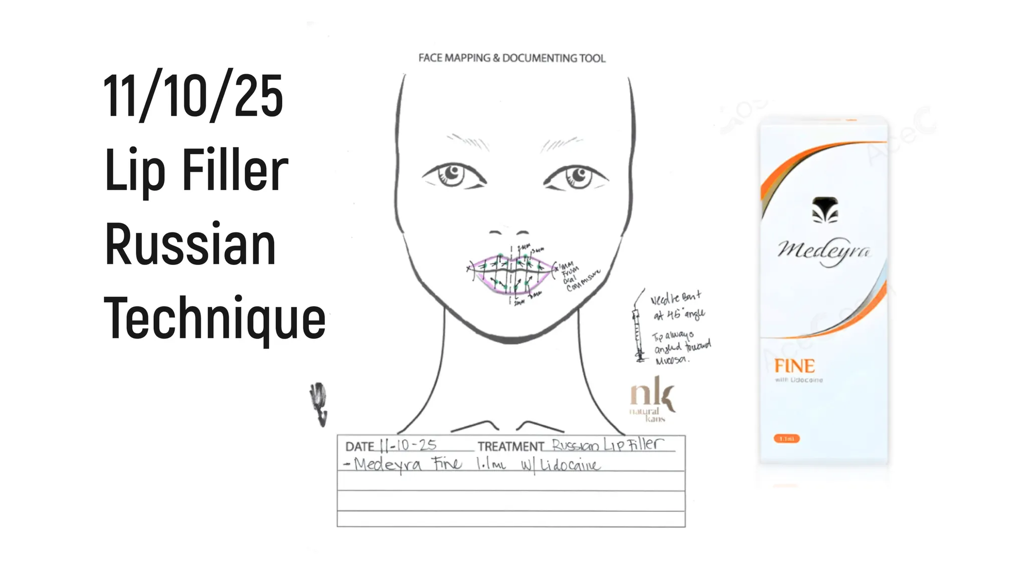 Every Injectable I Did in 2025: Full Timeline, Products Used & Why I Chose Them - treatment image