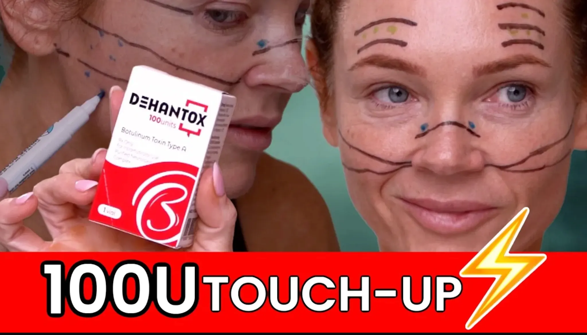 Every Injectable I Did in 2025: Full Timeline, Products Used & Why I Chose Them - treatment image