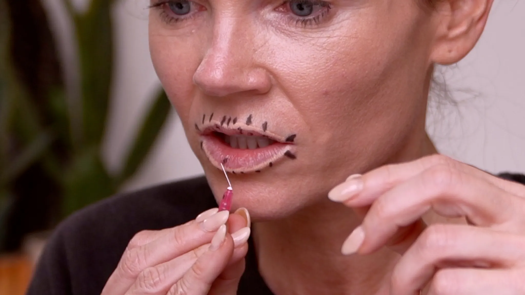 Russian Lip Filler Technique Explained: Why It Looks So Different - treatment image