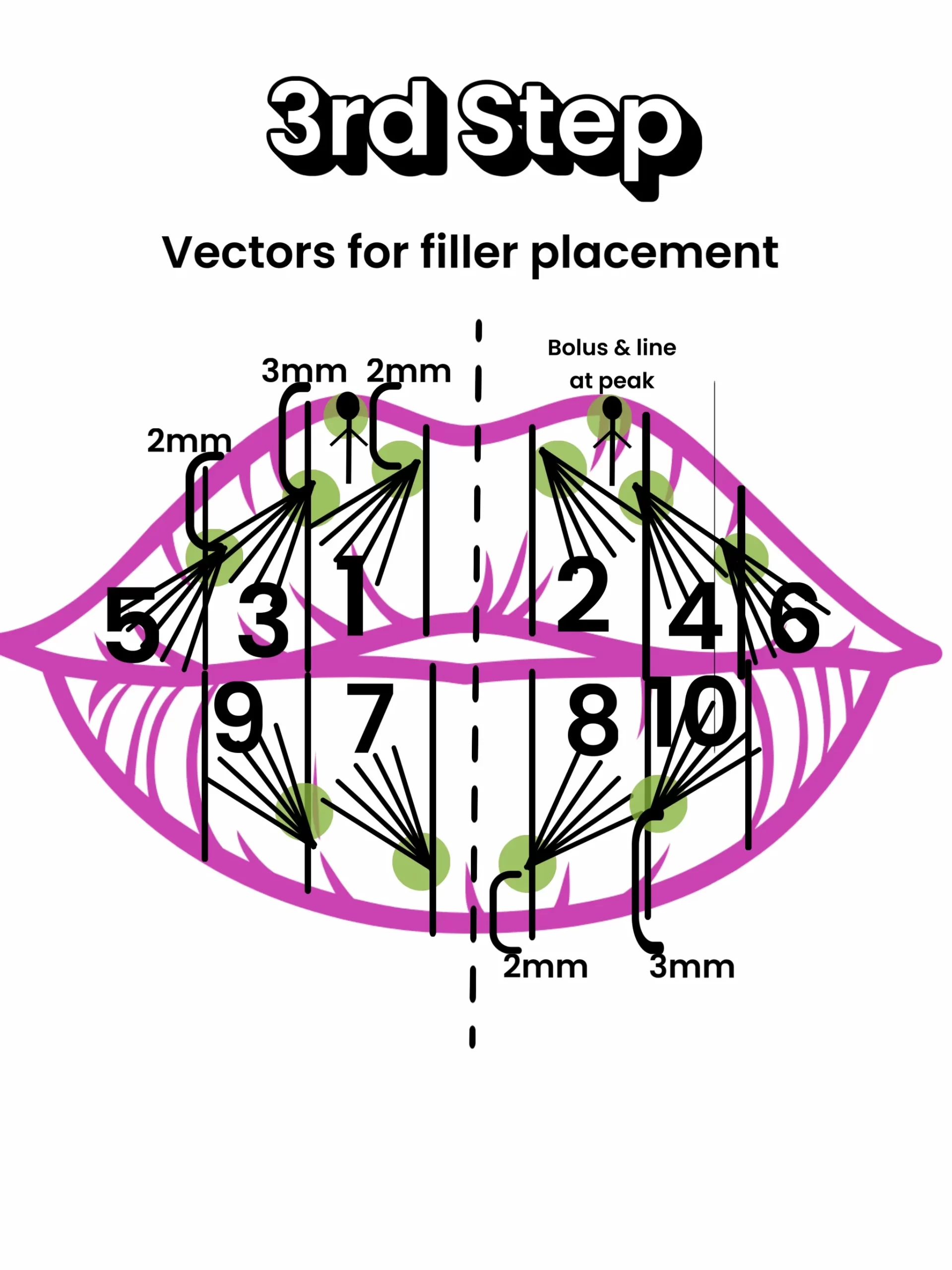 Russian Lip Filler Technique Explained: Why It Looks So Different - treatment image